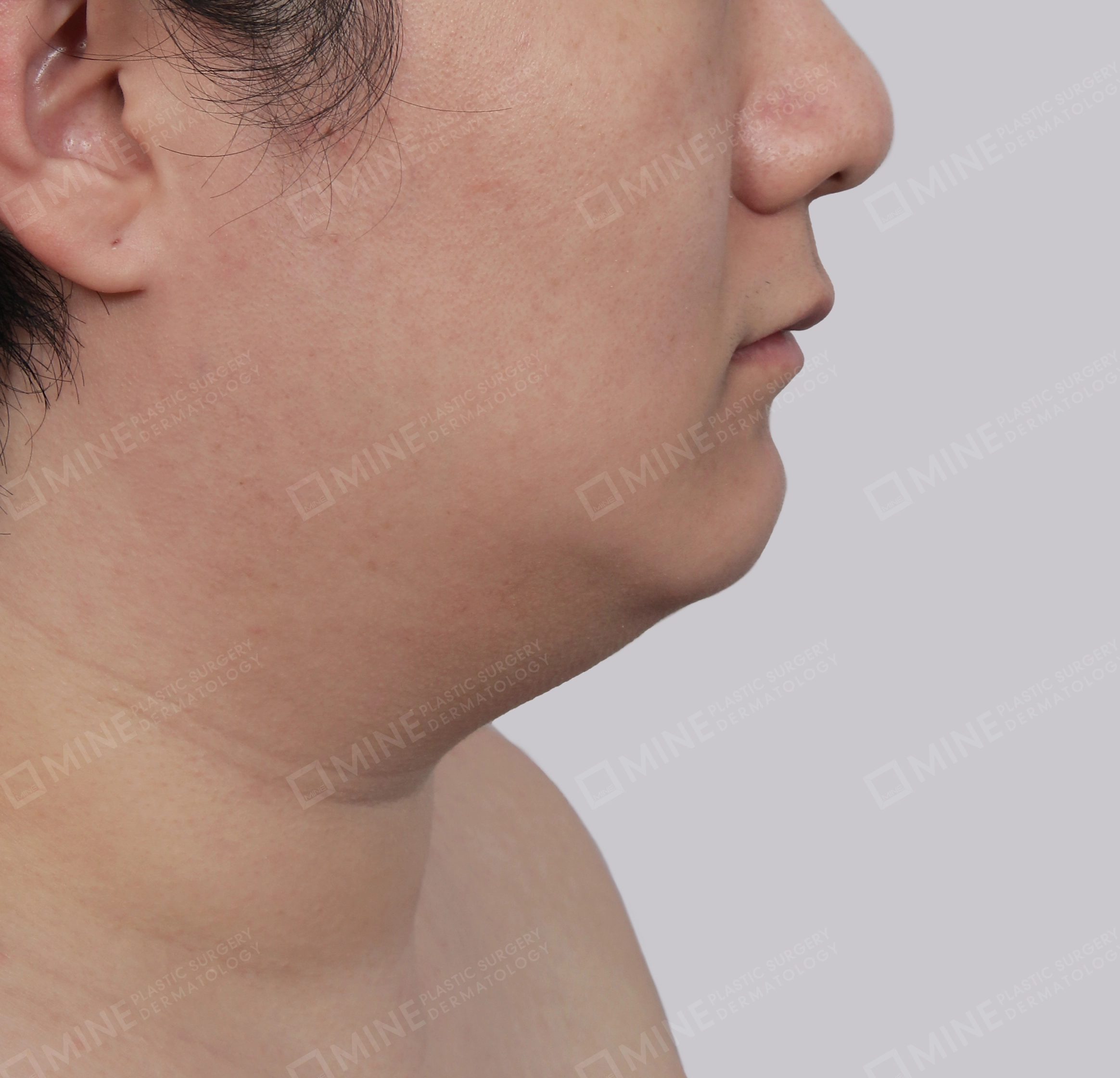 Mini Neck Lift-측면-전