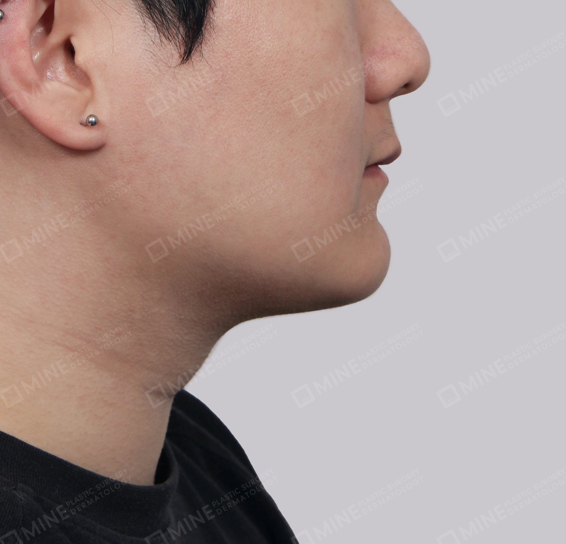 Mini Neck Lift-측면-후