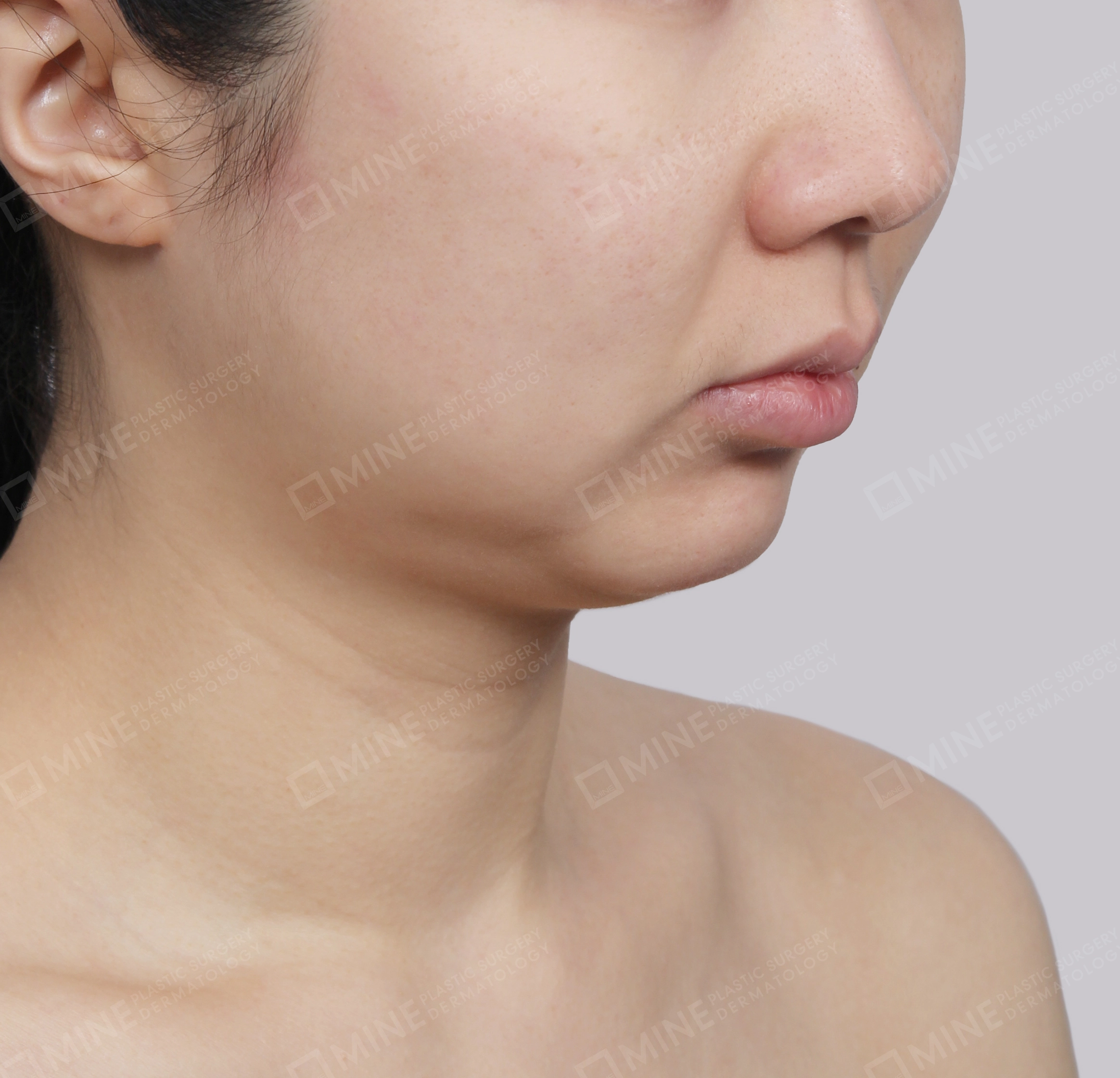 Mini Neck Lift-정면-전