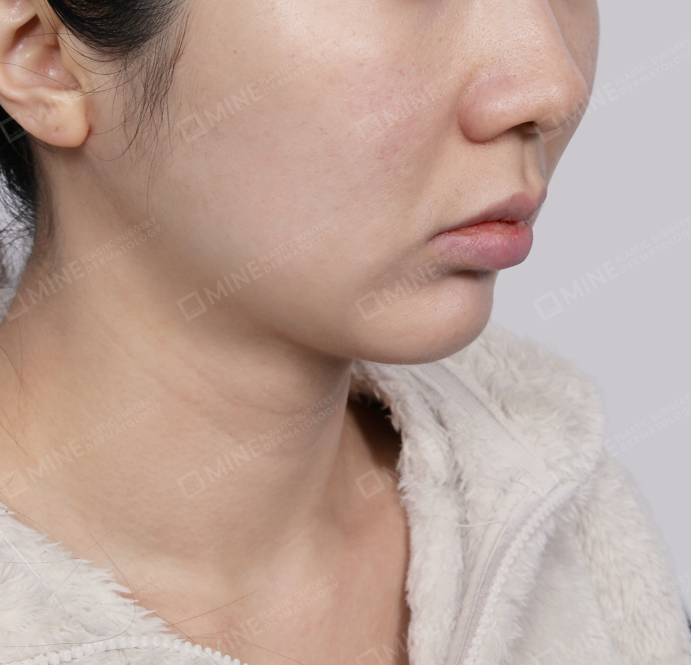 Mini Neck Lift-정면-후