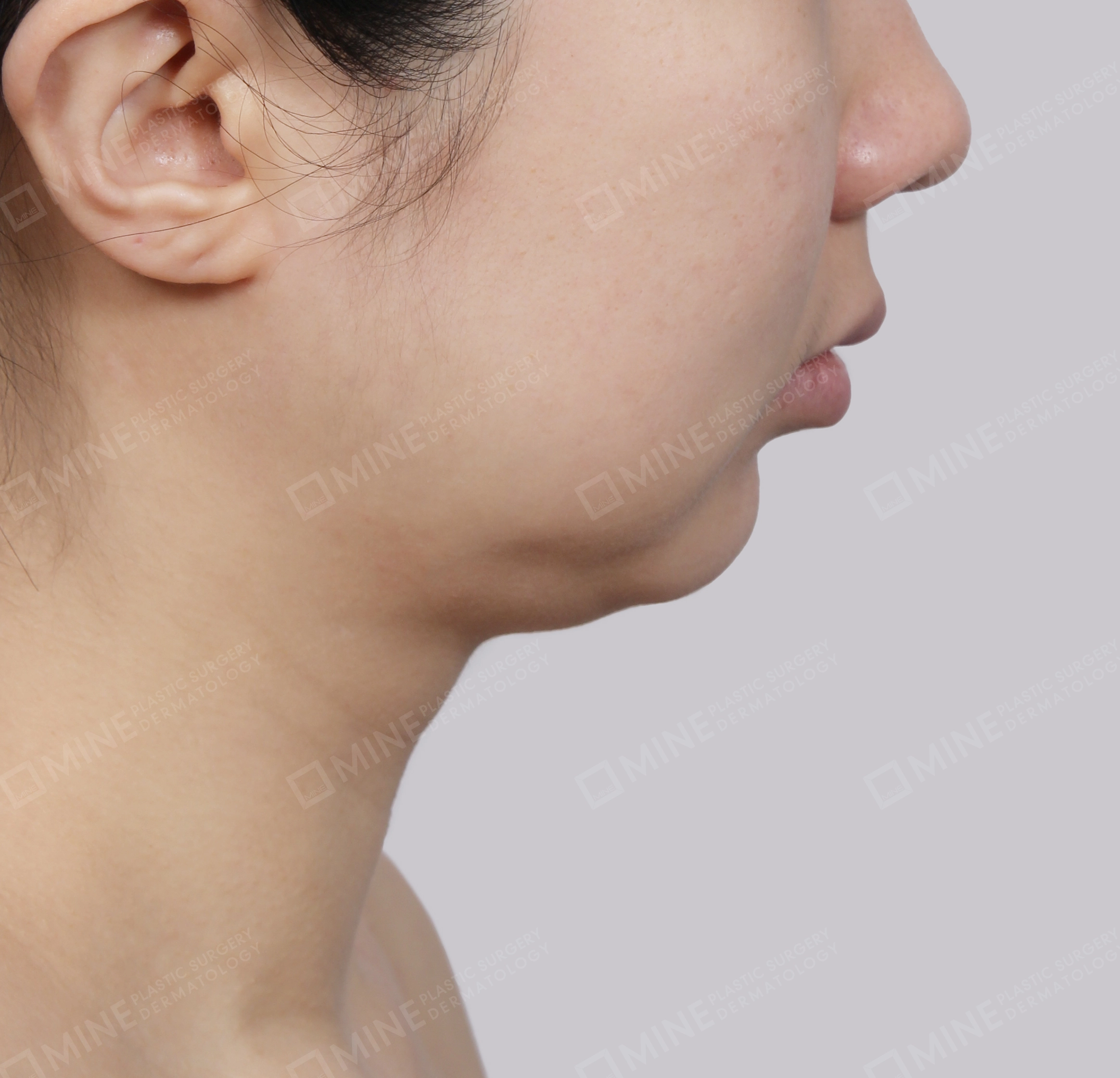 Mini Neck Lift-측면-전