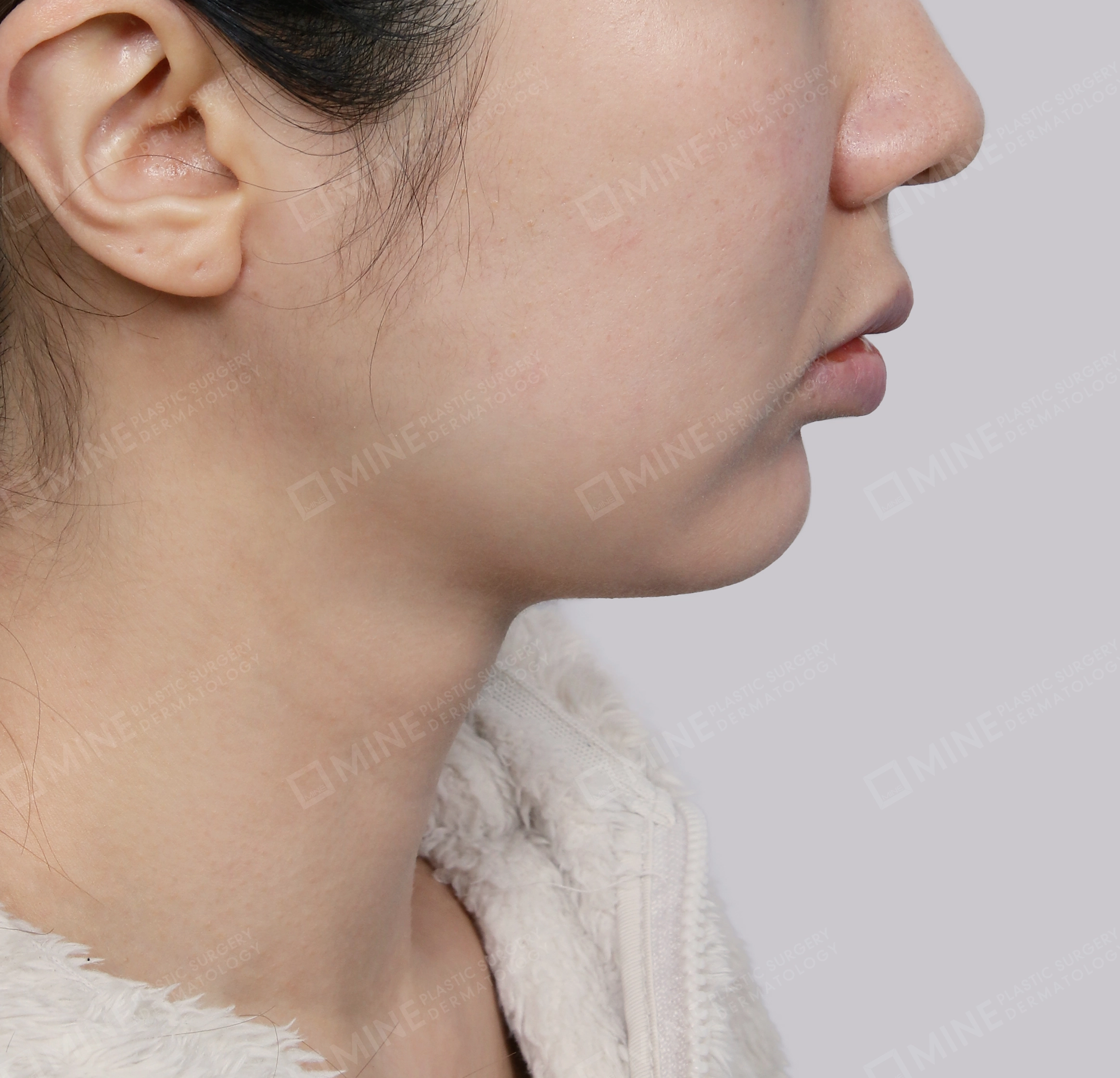 Mini Neck Lift-측면-후