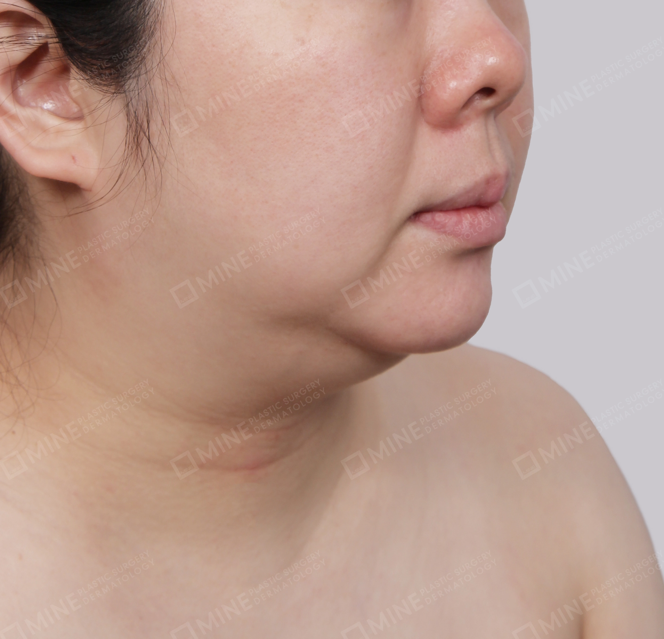 Mini Neck Lift-정면-전
