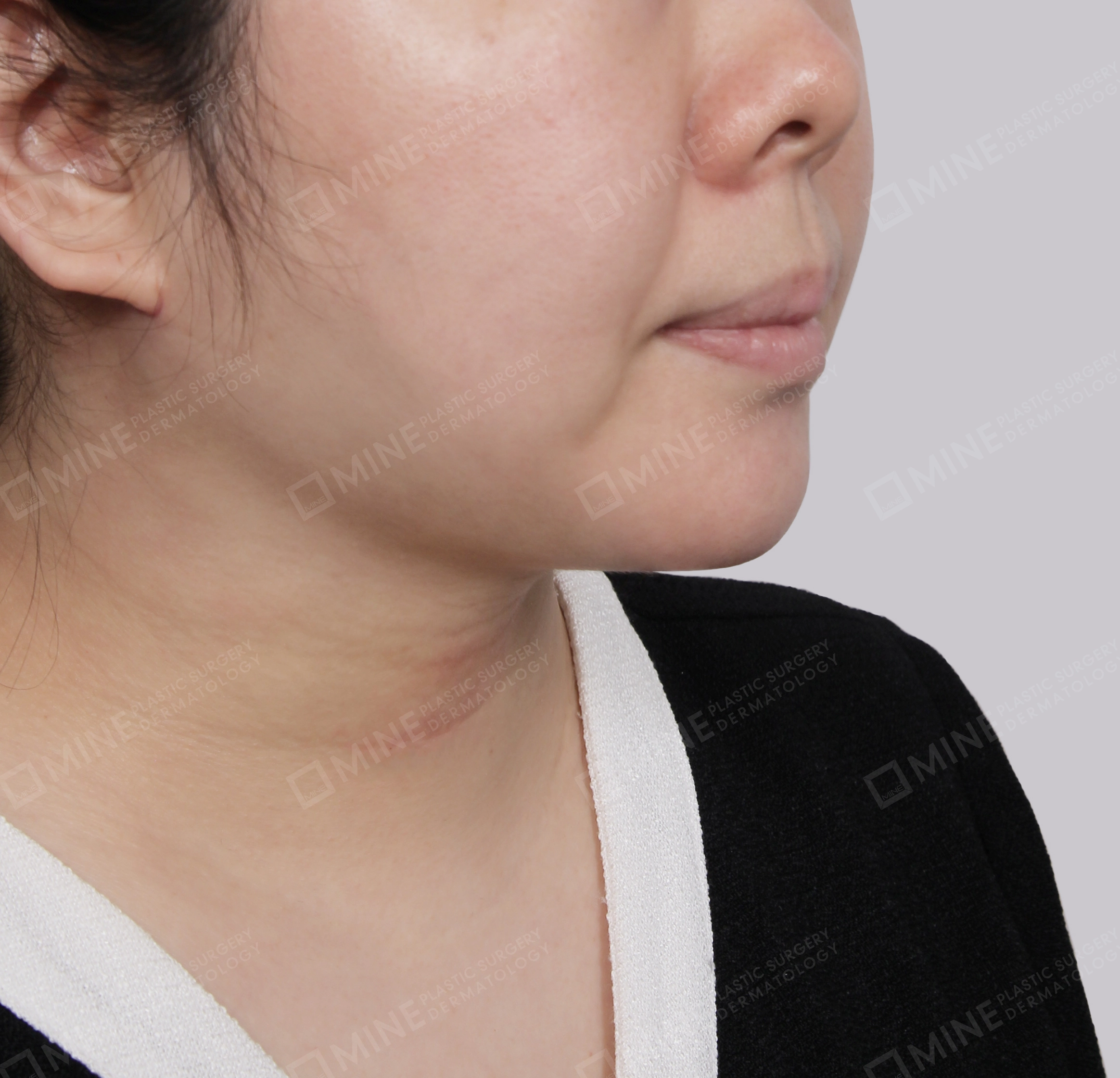 Mini Neck Lift-정면-후