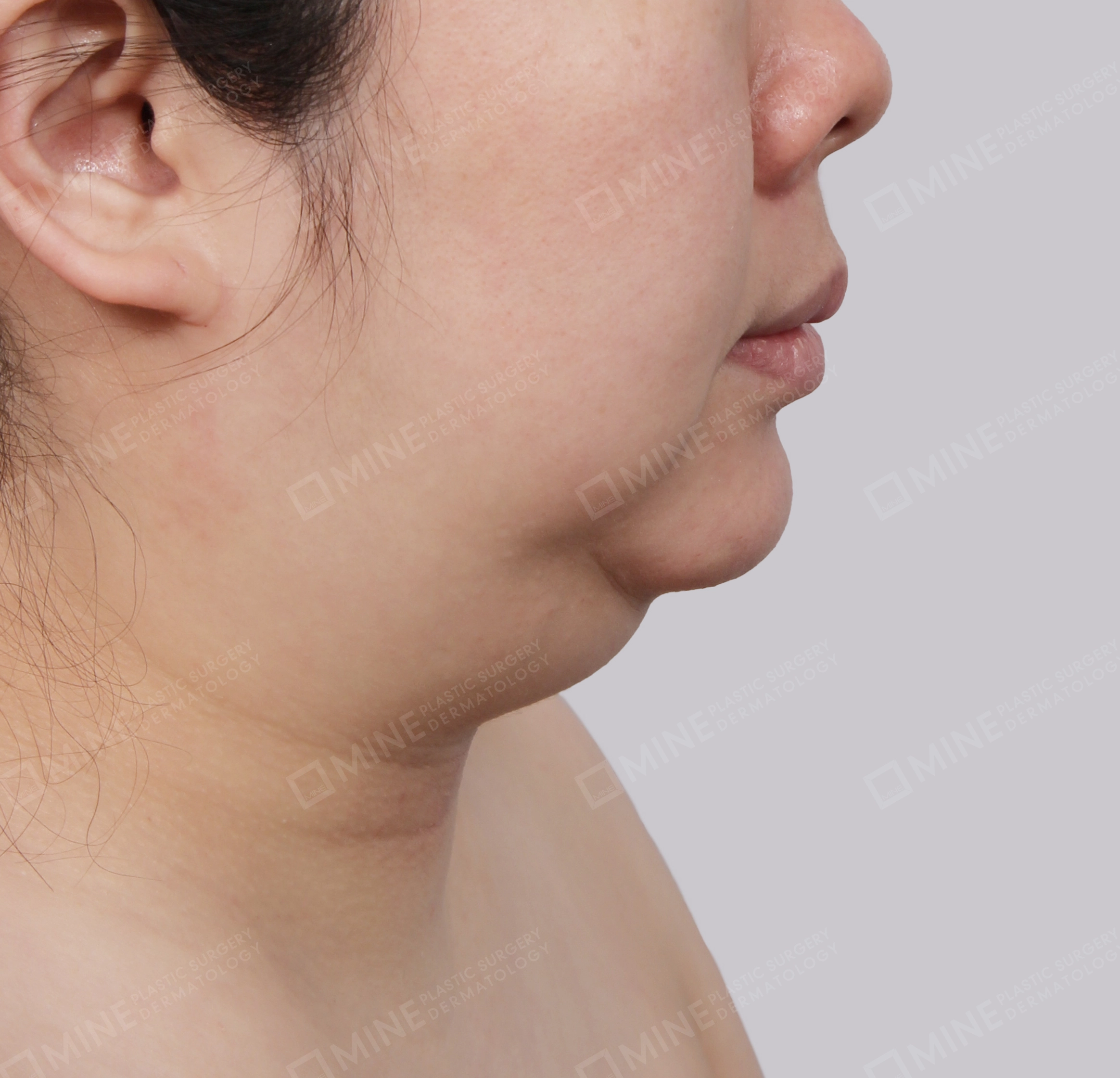 Mini Neck Lift-측면-전