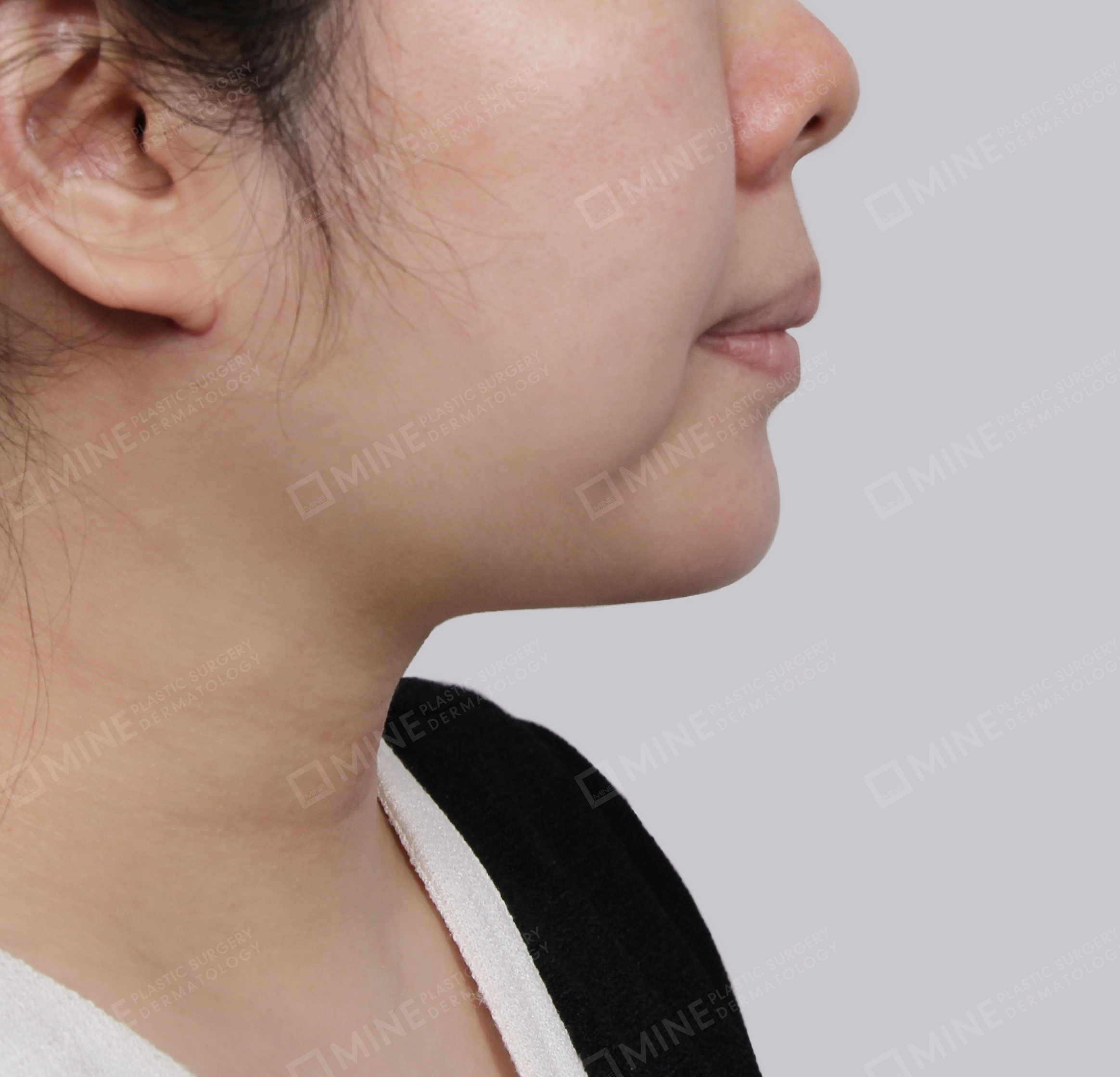 Mini Neck Lift-측면-후