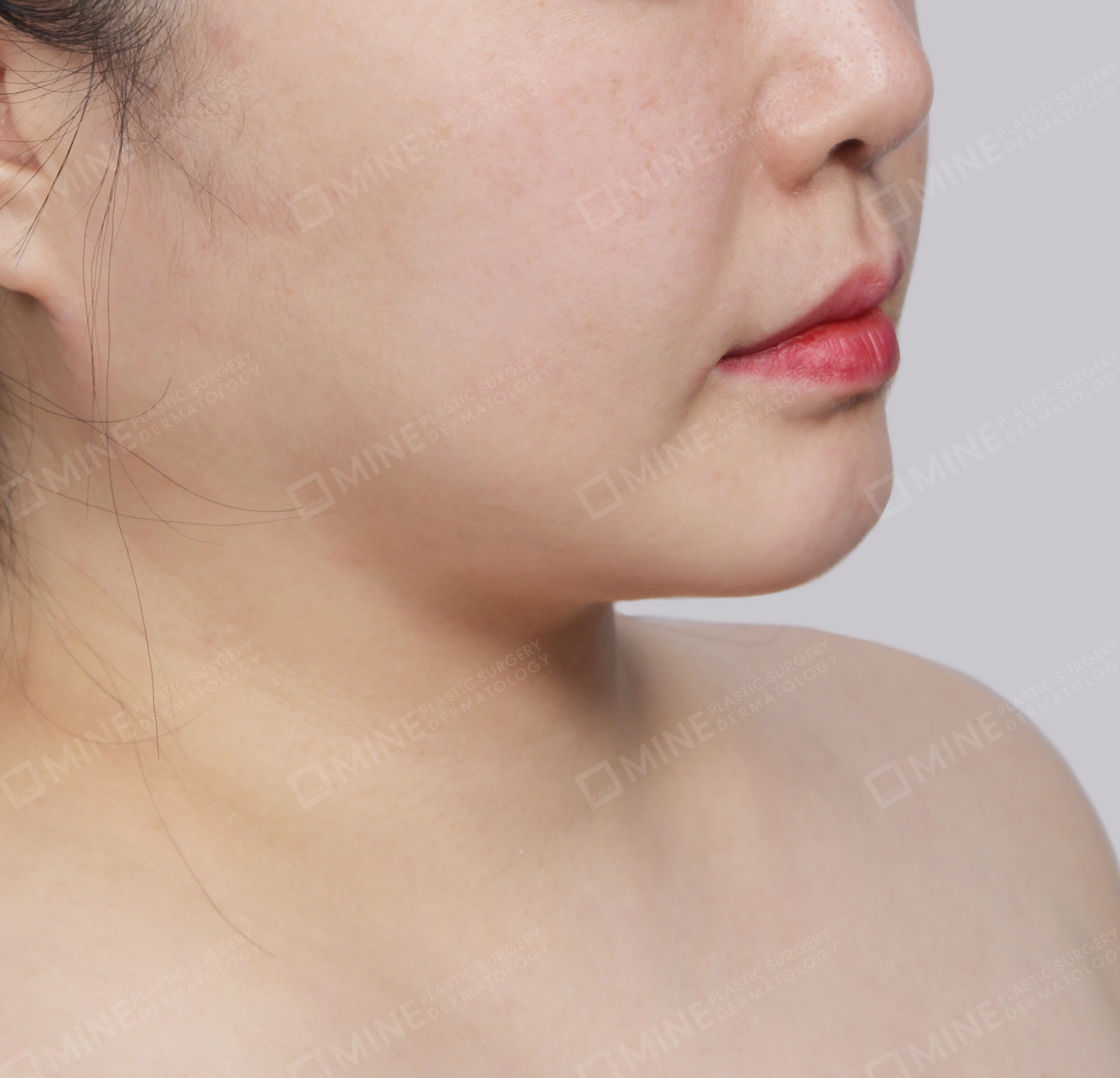 Mini Neck Lift-정면-전