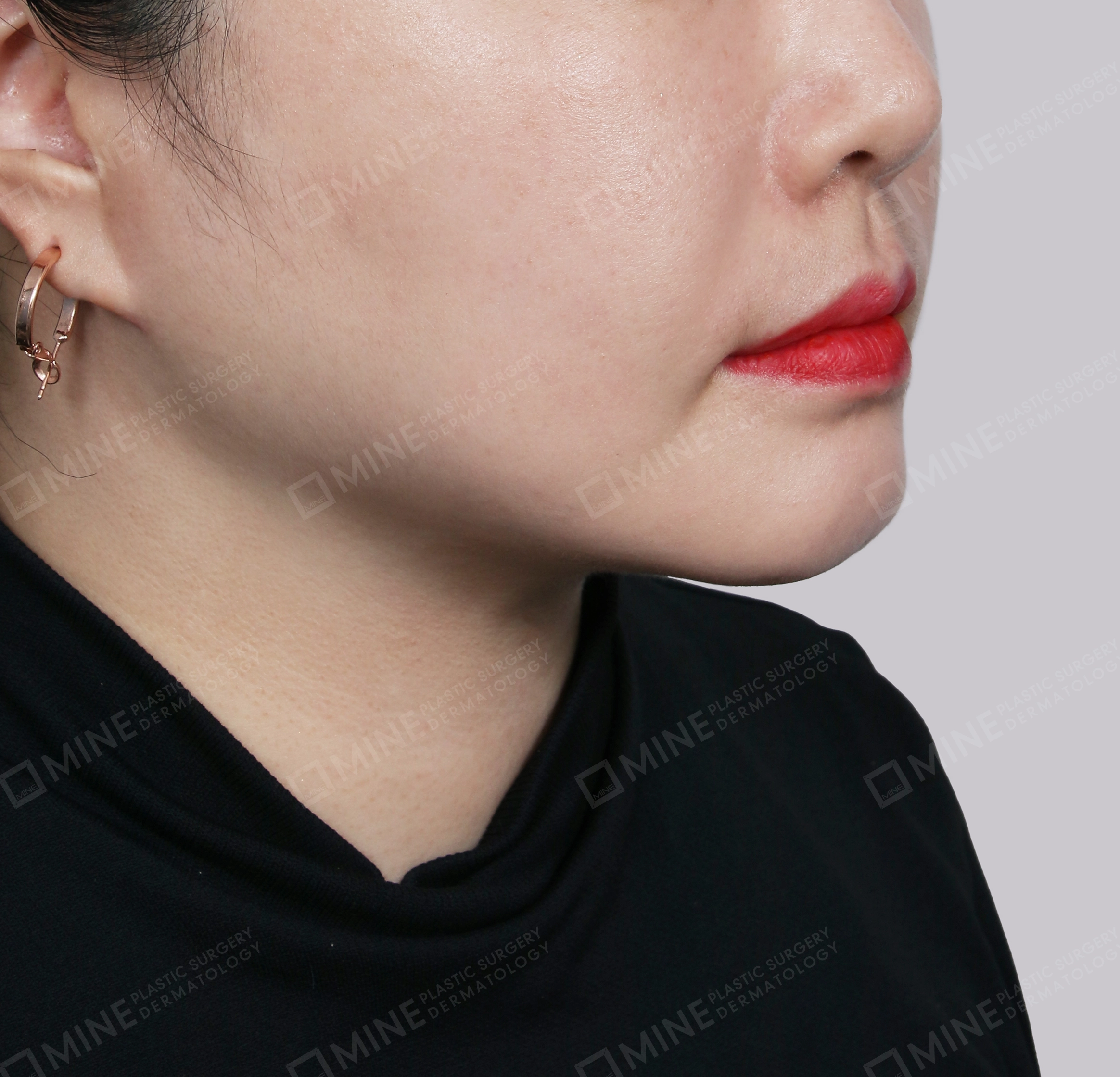 Mini Neck Lift-정면-후