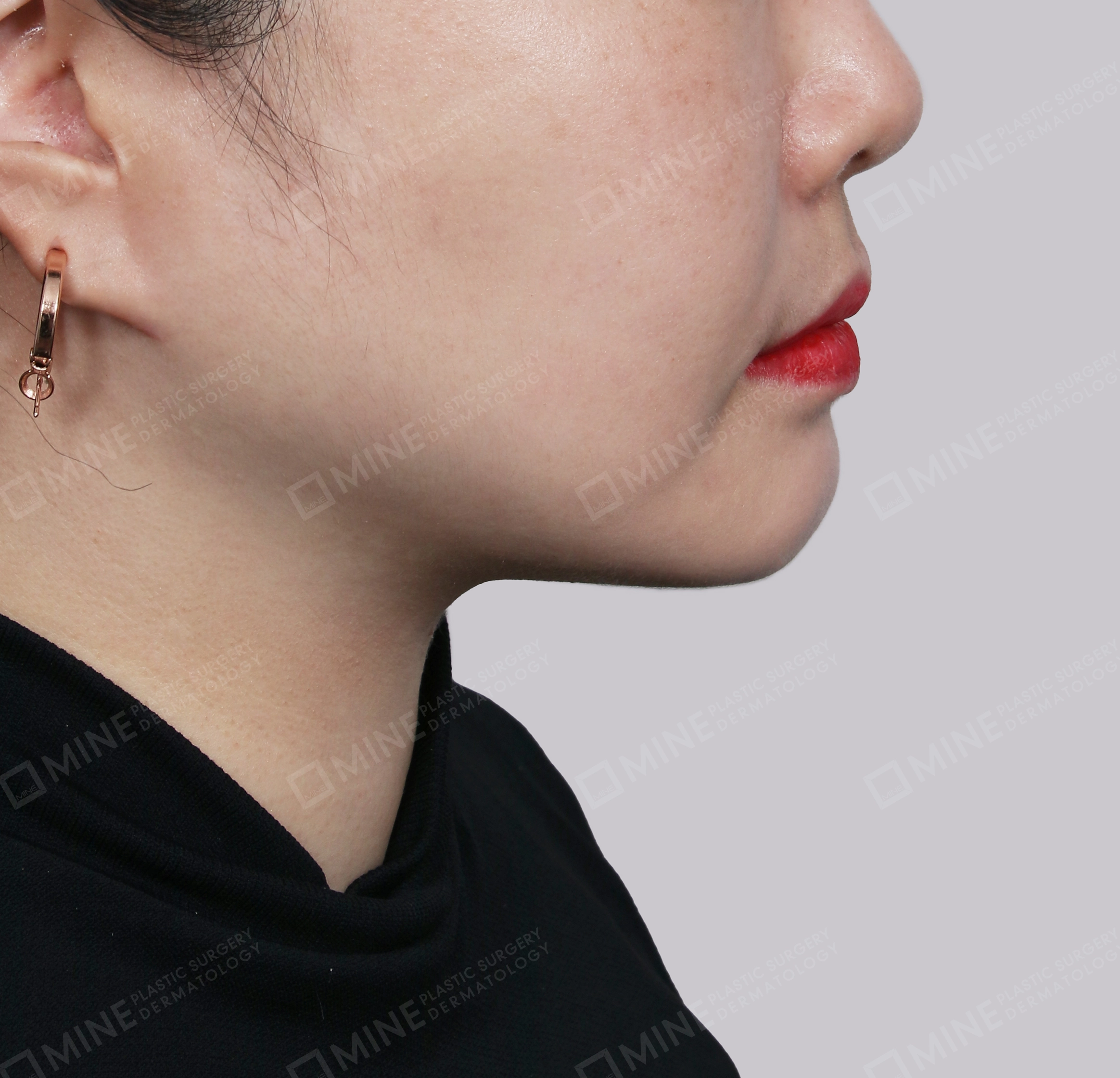 Mini Neck Lift-측면-후