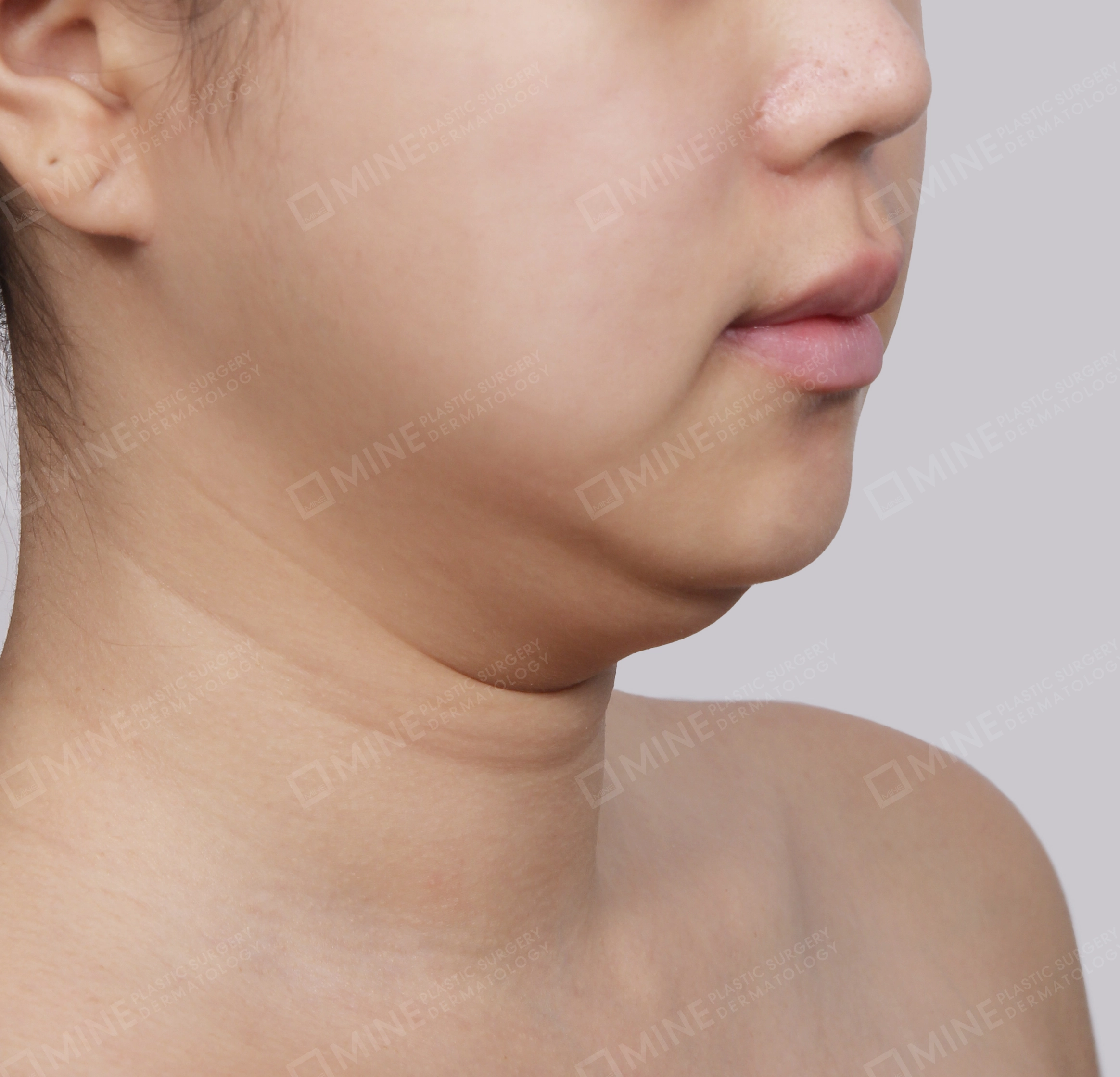 Mini Neck Lift-정면-전