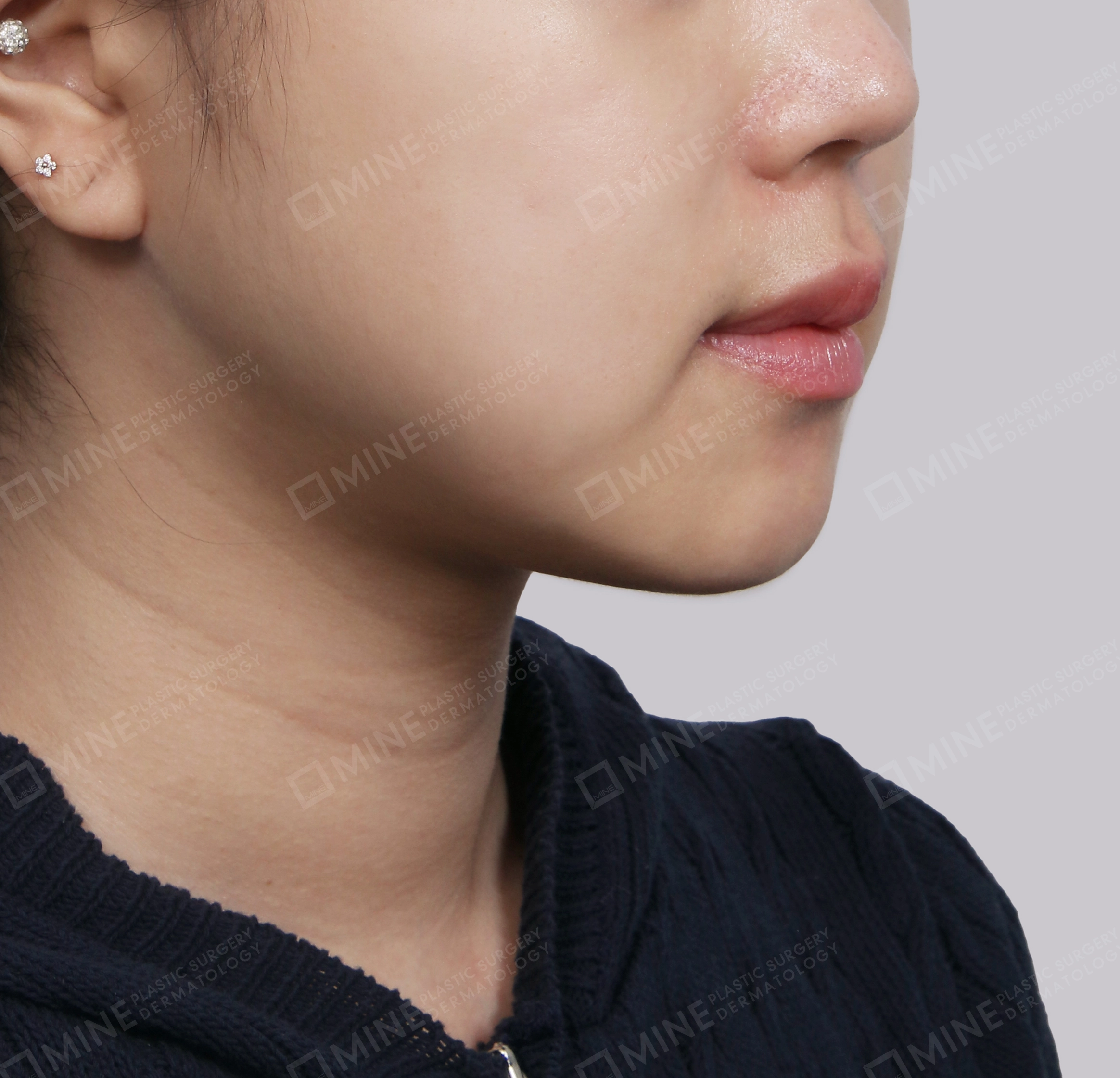 Mini Neck Lift-정면-후