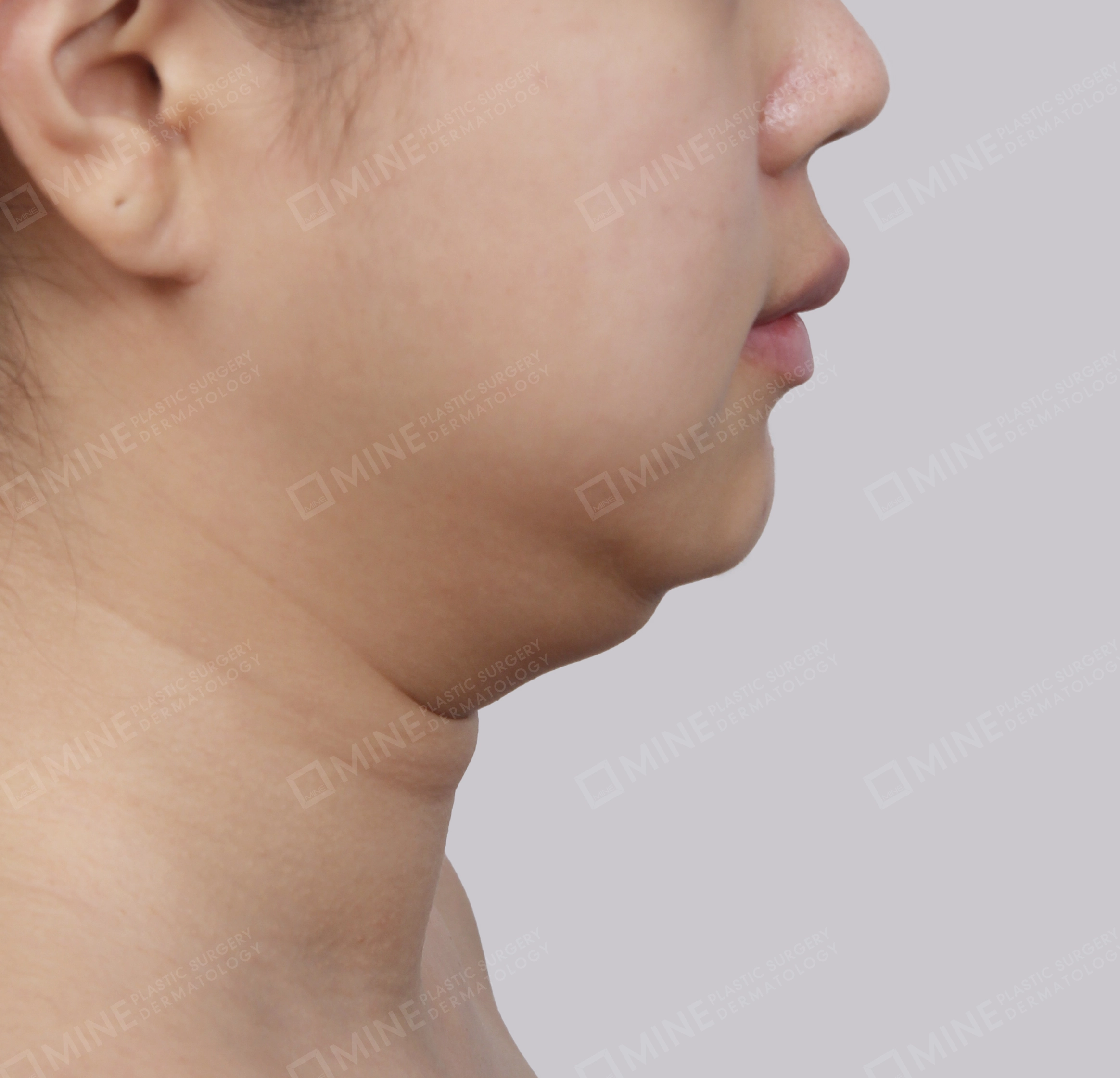 Mini Neck Lift-측면-전