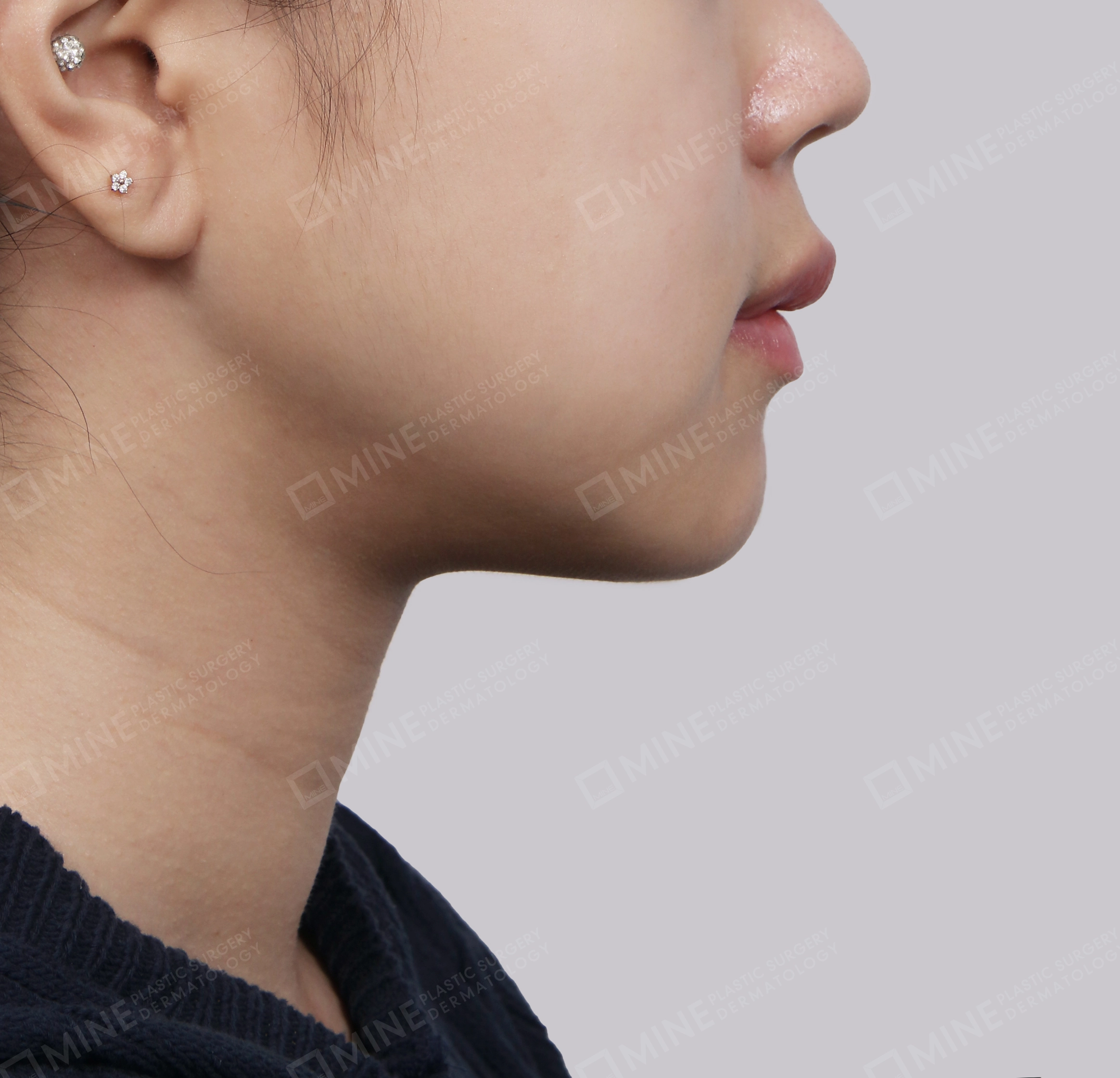 Mini Neck Lift-측면-후
