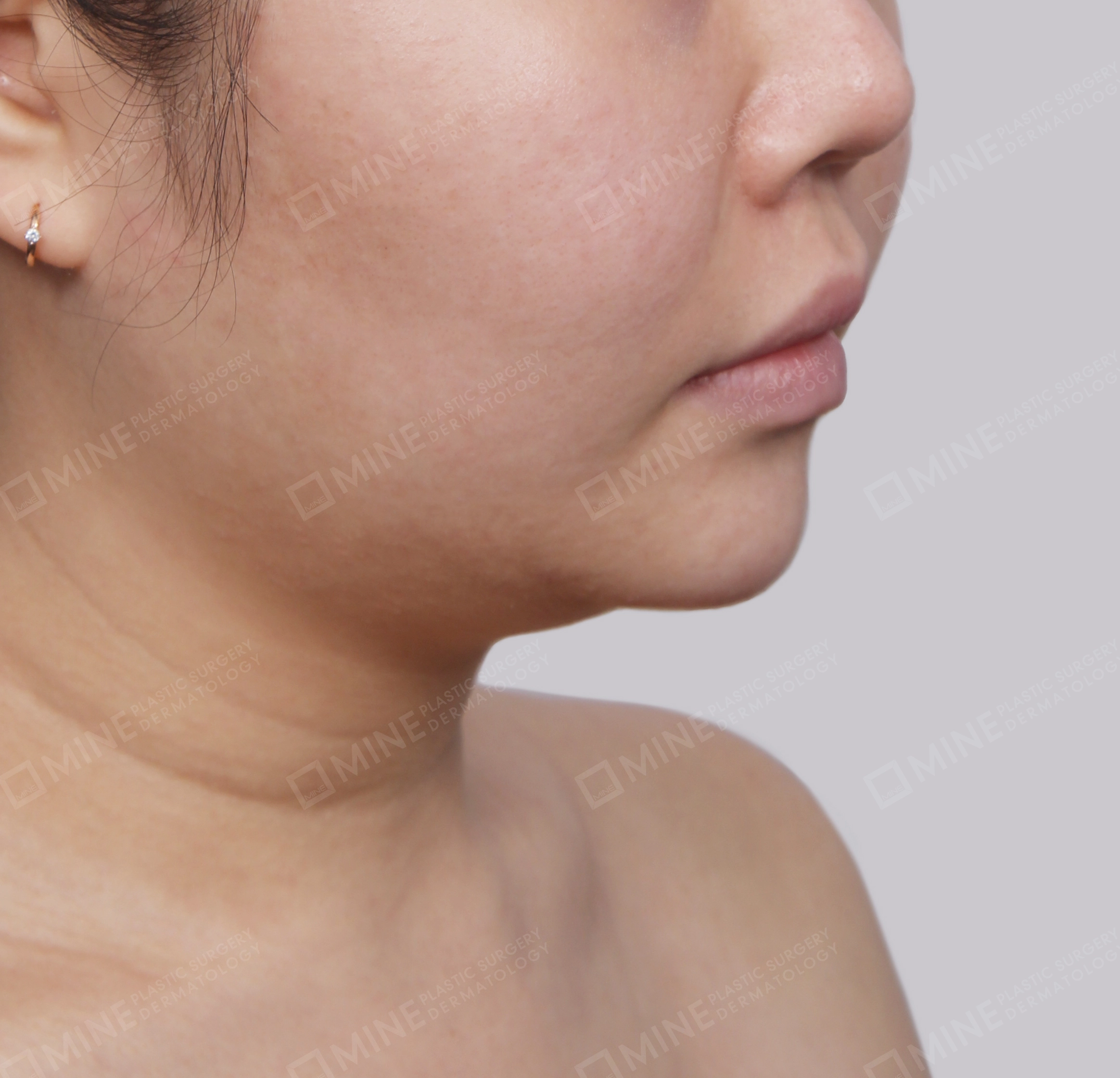 Mini Neck Lift-정면-전