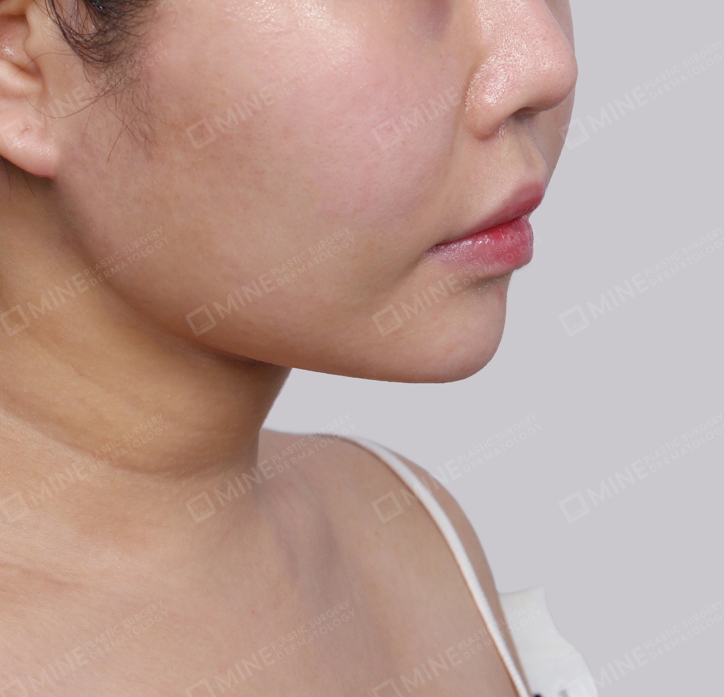 Mini Neck Lift-정면-후