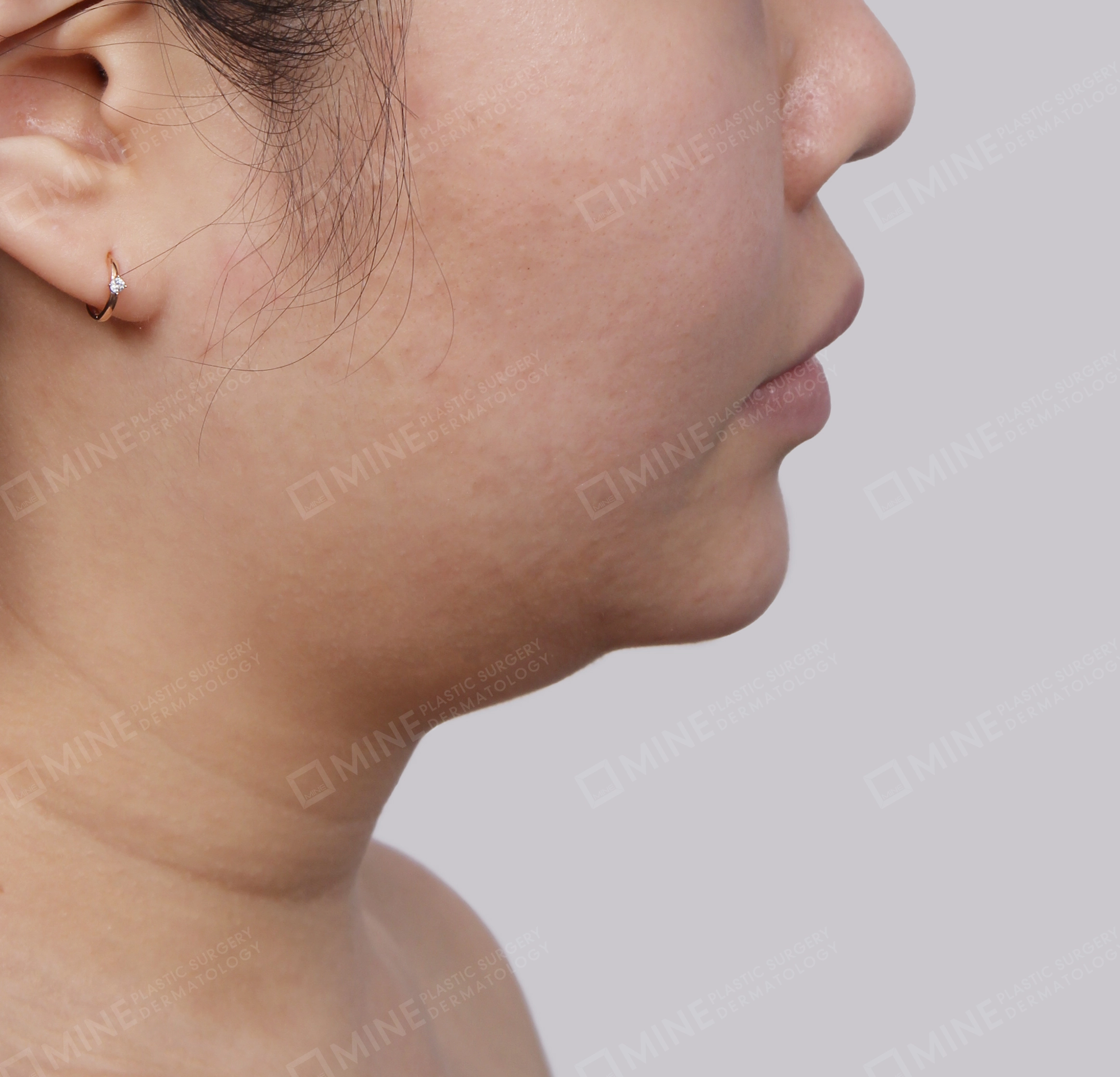 Mini Neck Lift-측면-전