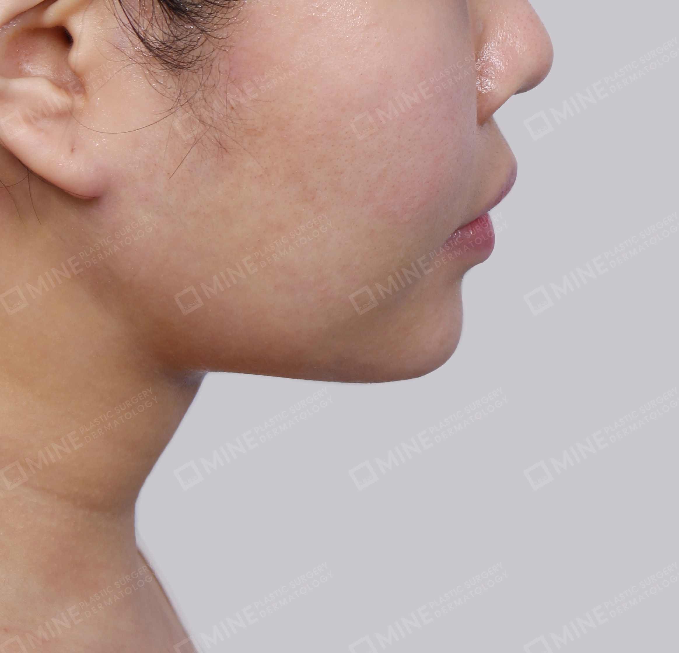 Mini Neck Lift-측면-후
