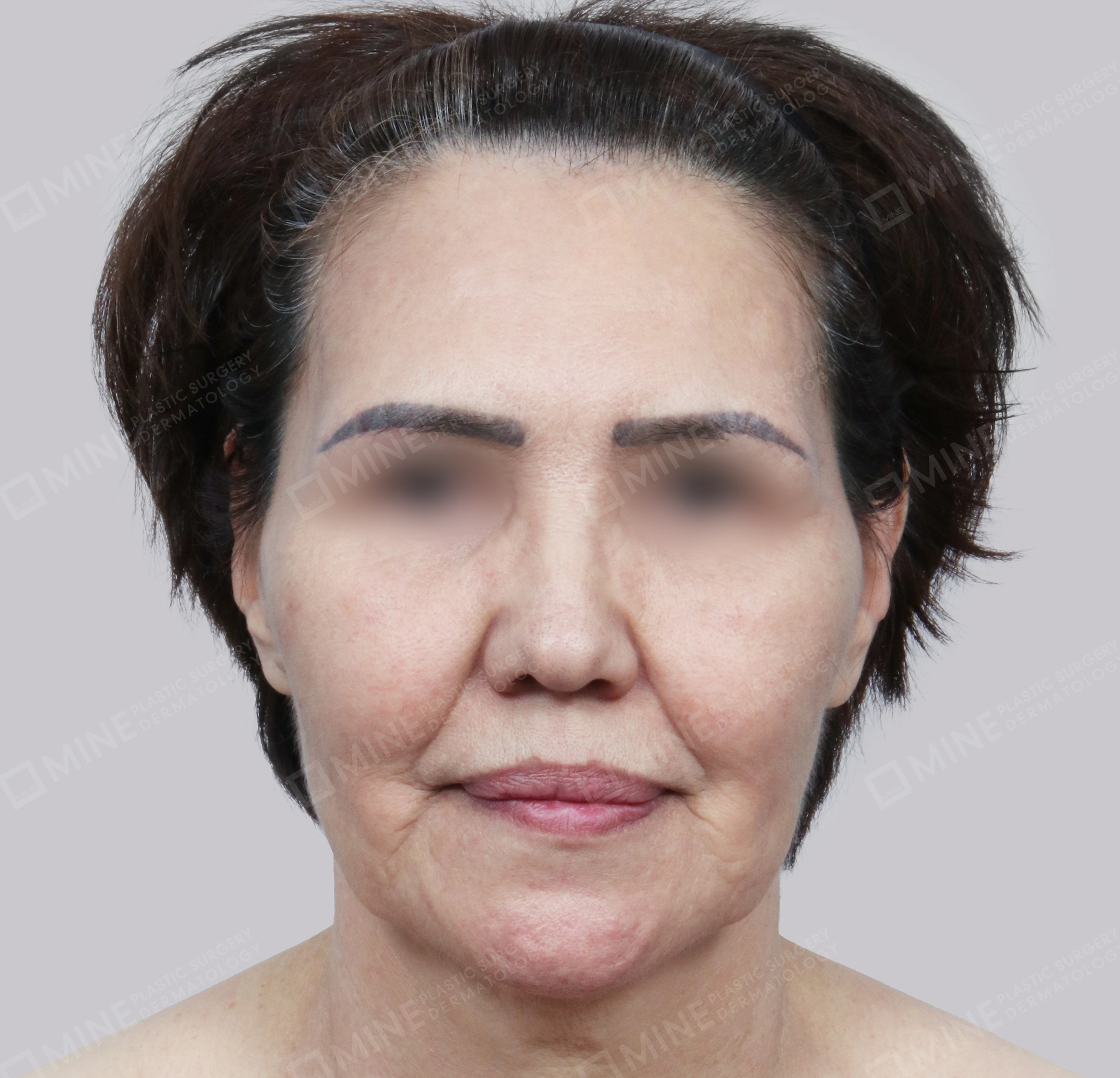 SMAS Face Lift-정면-전