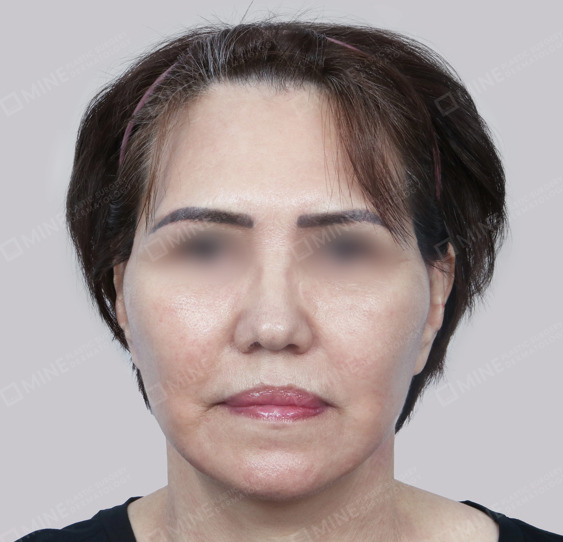 SMAS Face Lift-정면-후