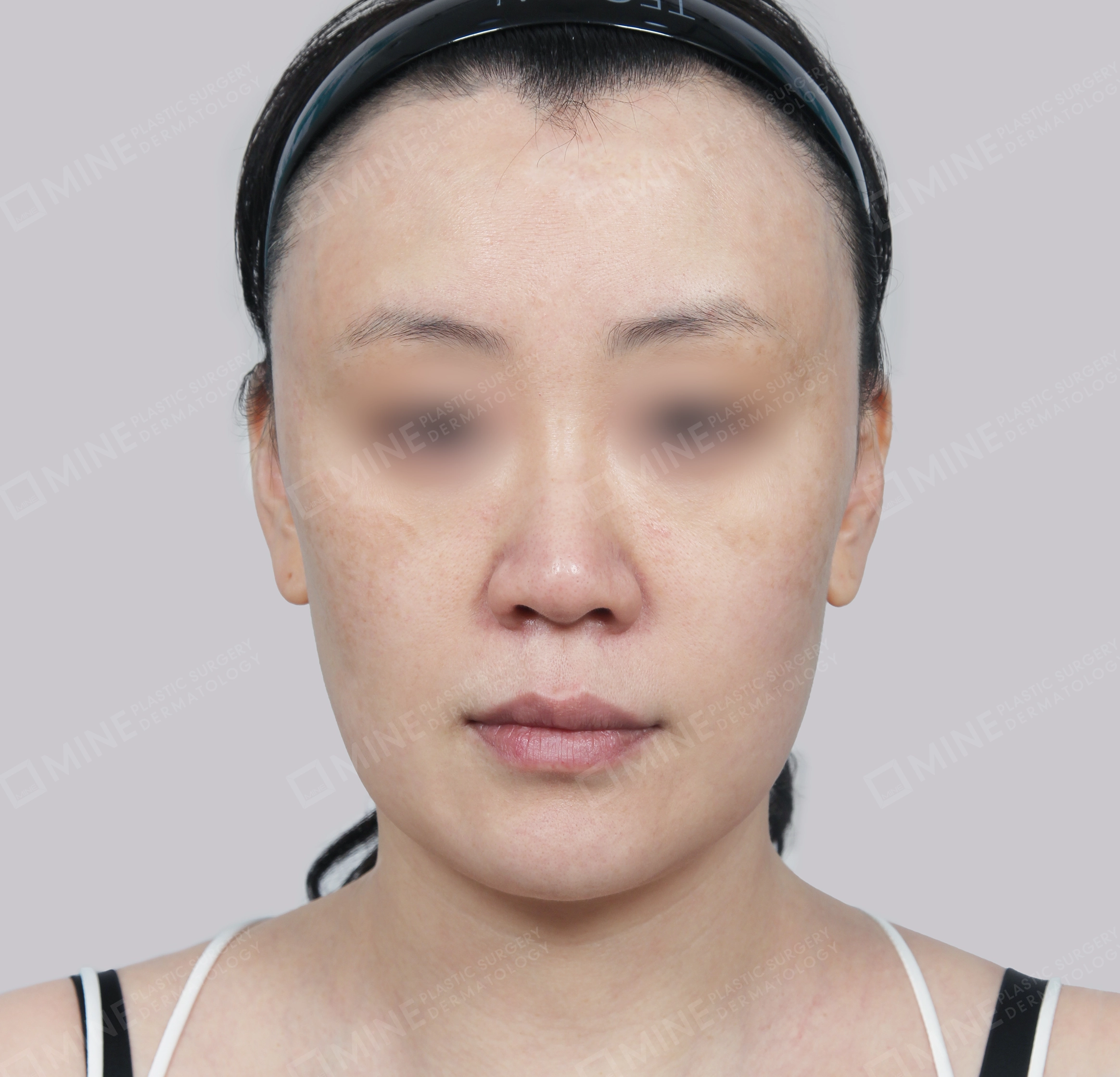 SMAS Face Lift-정면-전