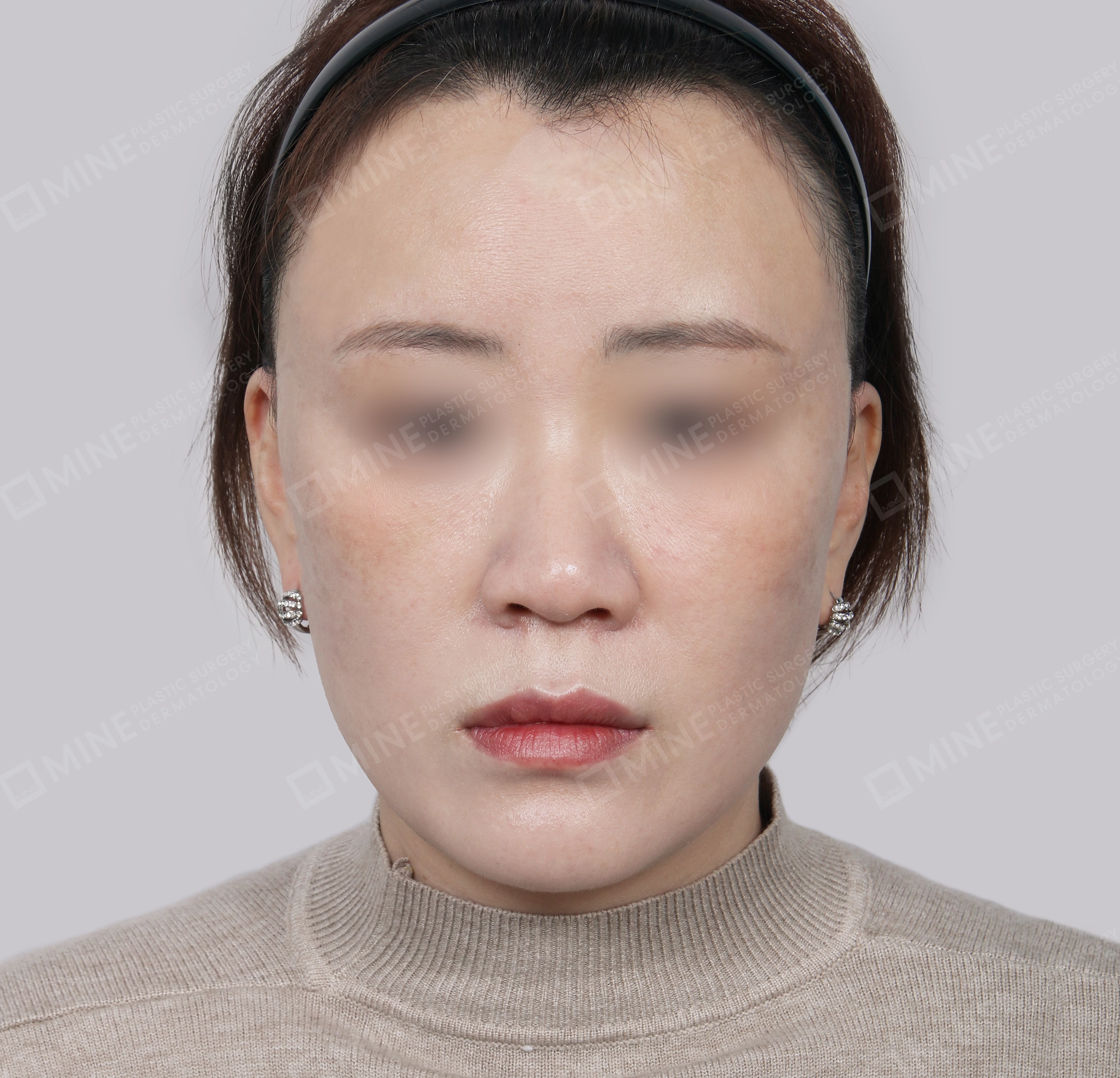 SMAS Face Lift-정면-후