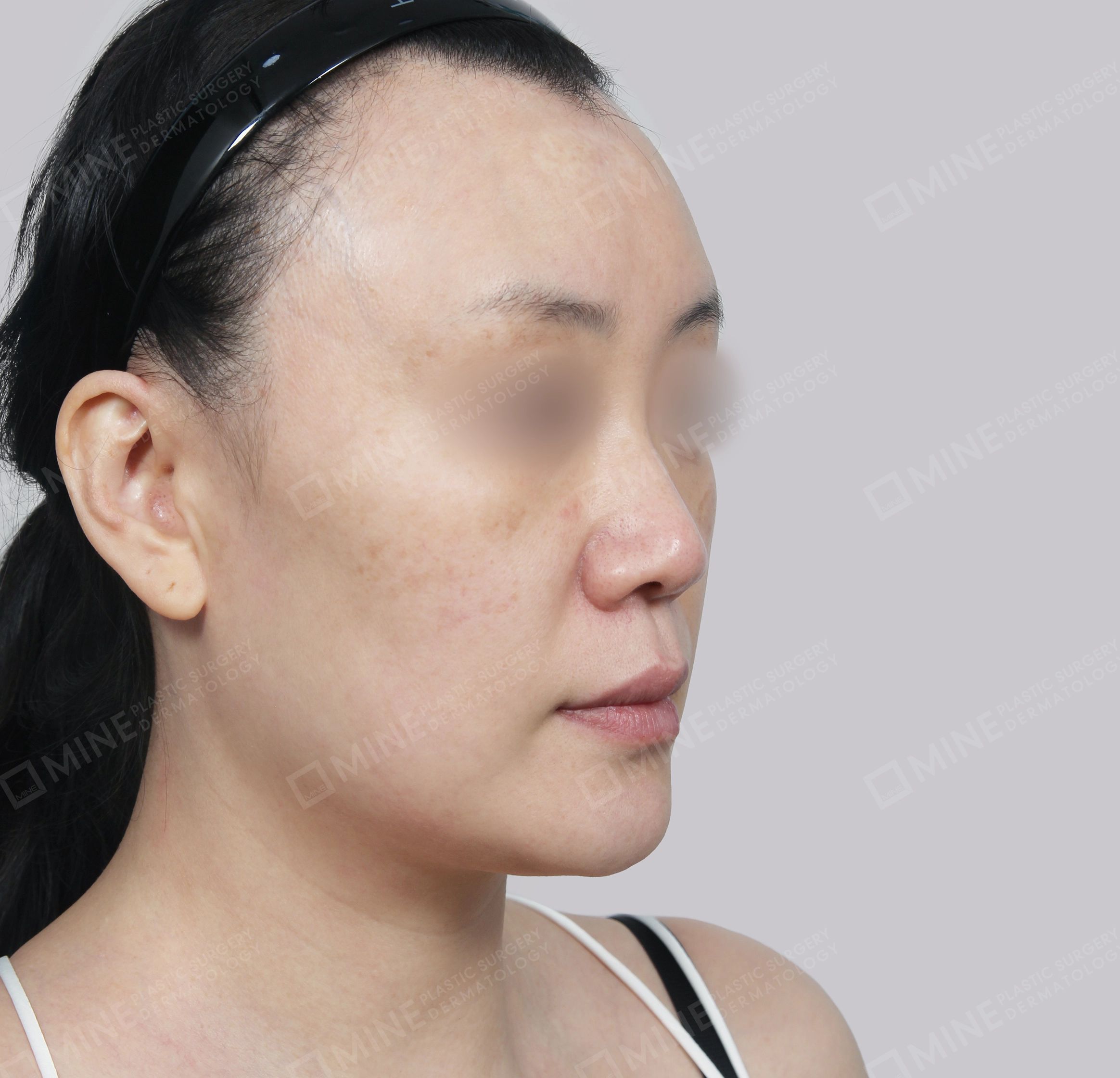 SMAS Face Lift-45도-전
