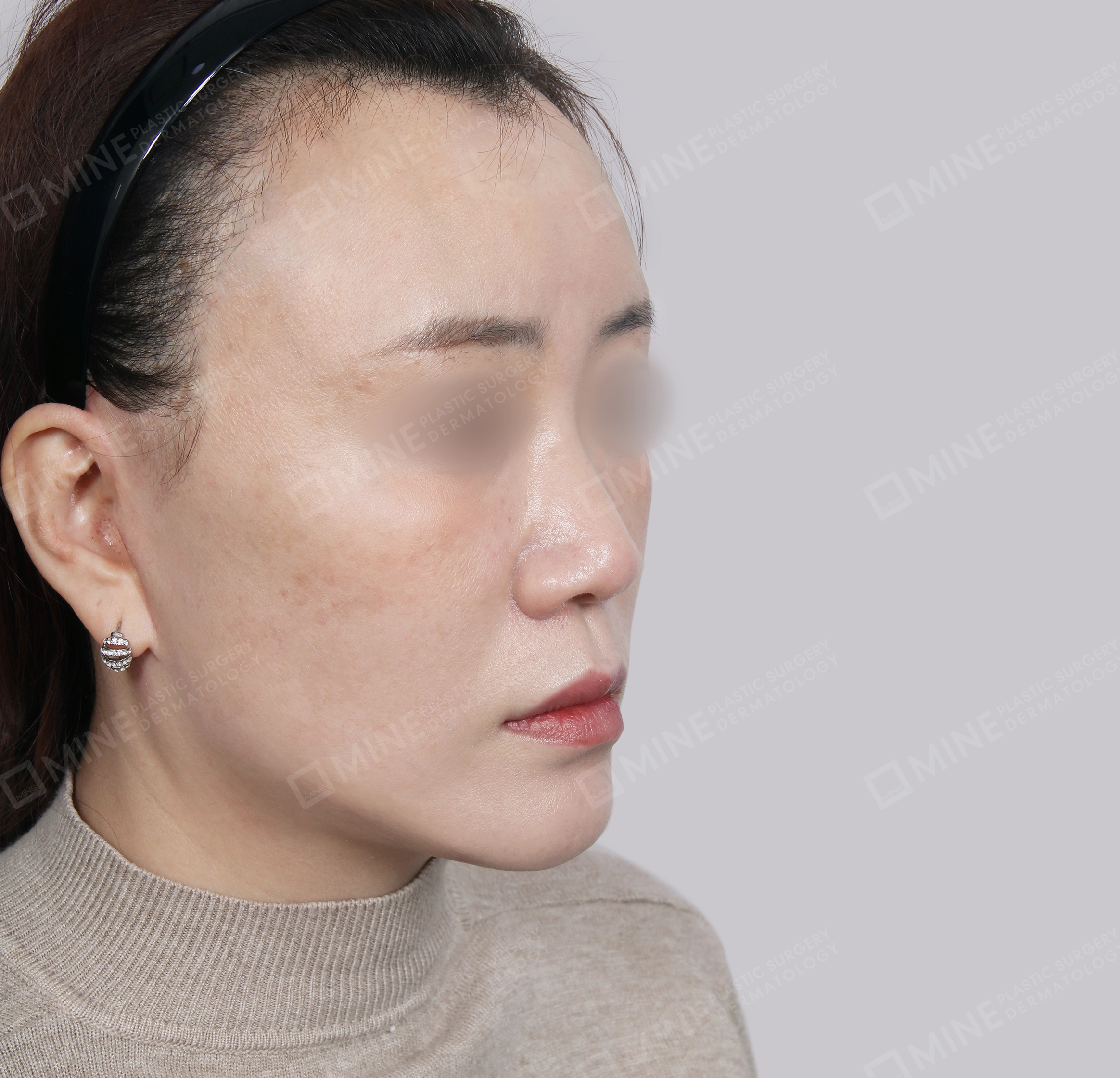 SMAS Face Lift-45도-후