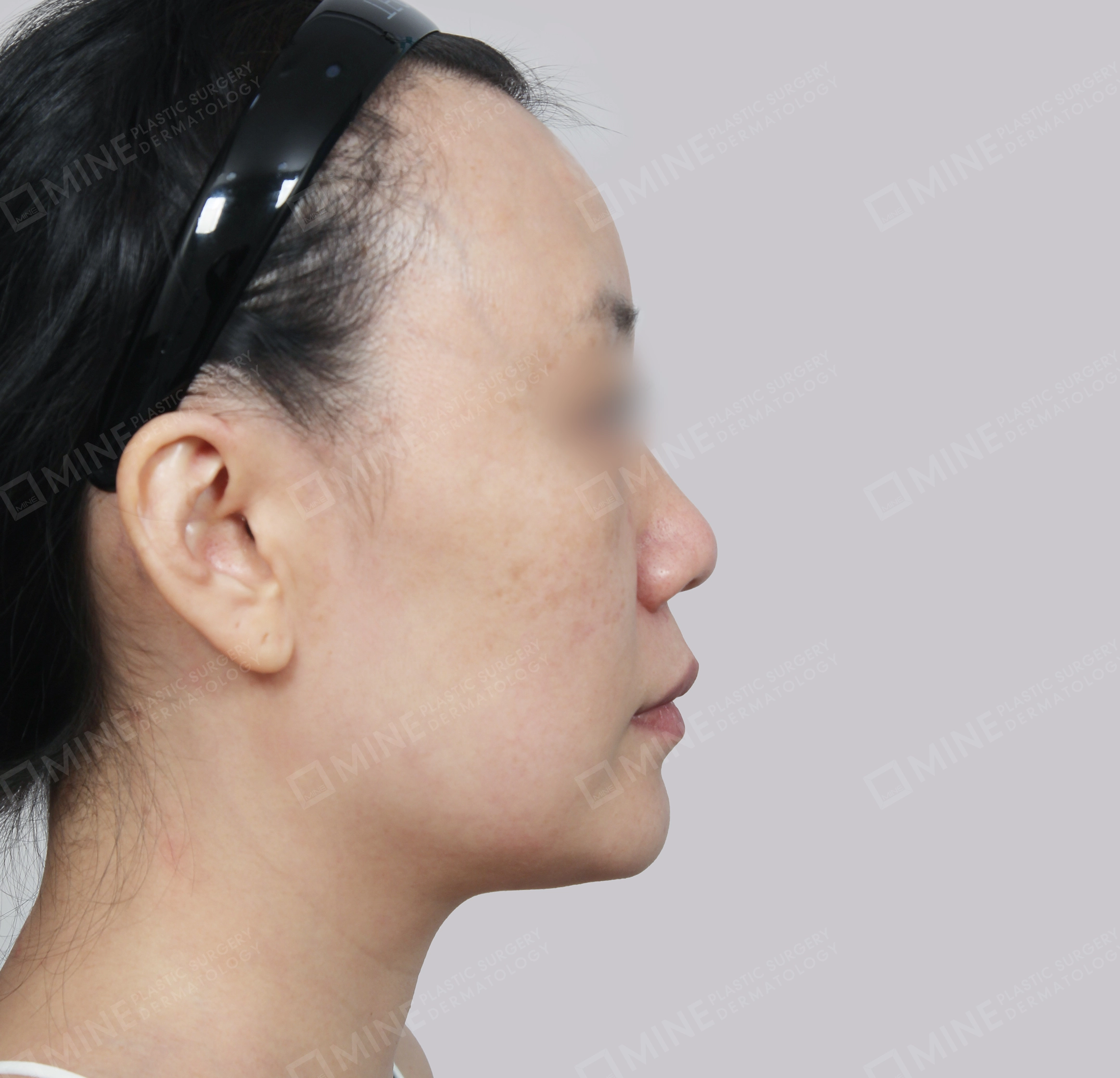 SMAS Face Lift-측면-전