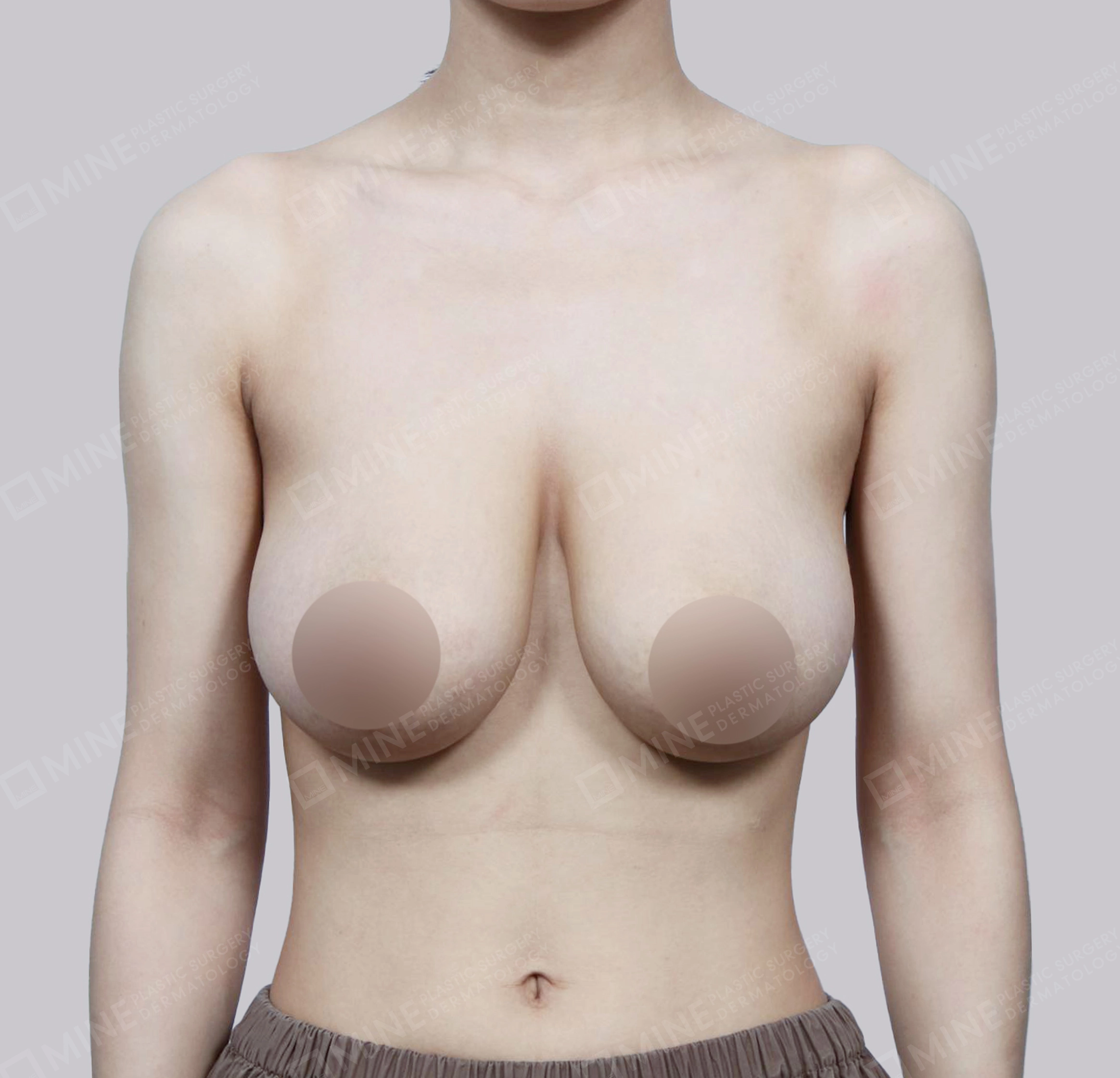 Breast Reduction-정면-전