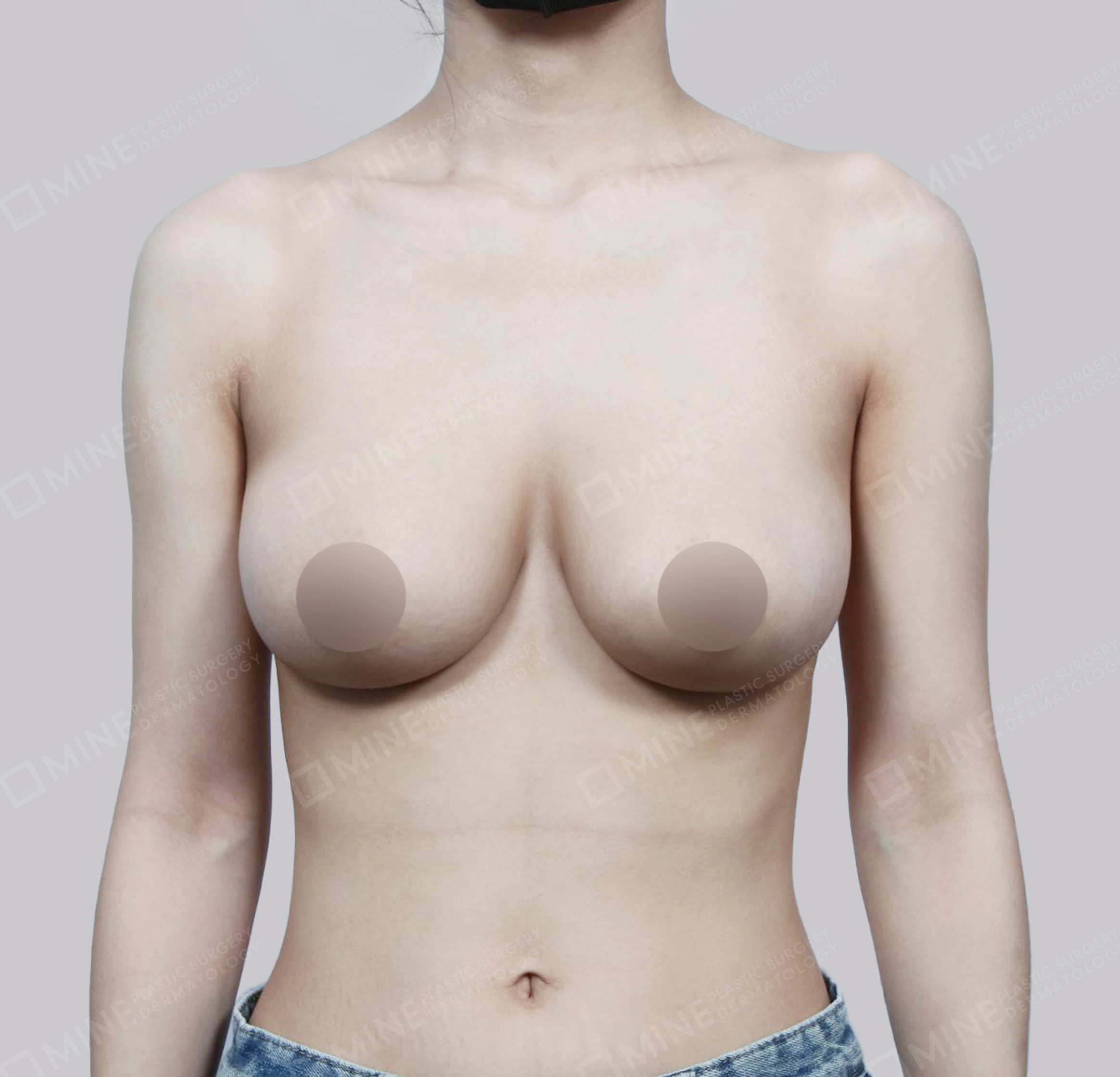 Breast Reduction-정면-후