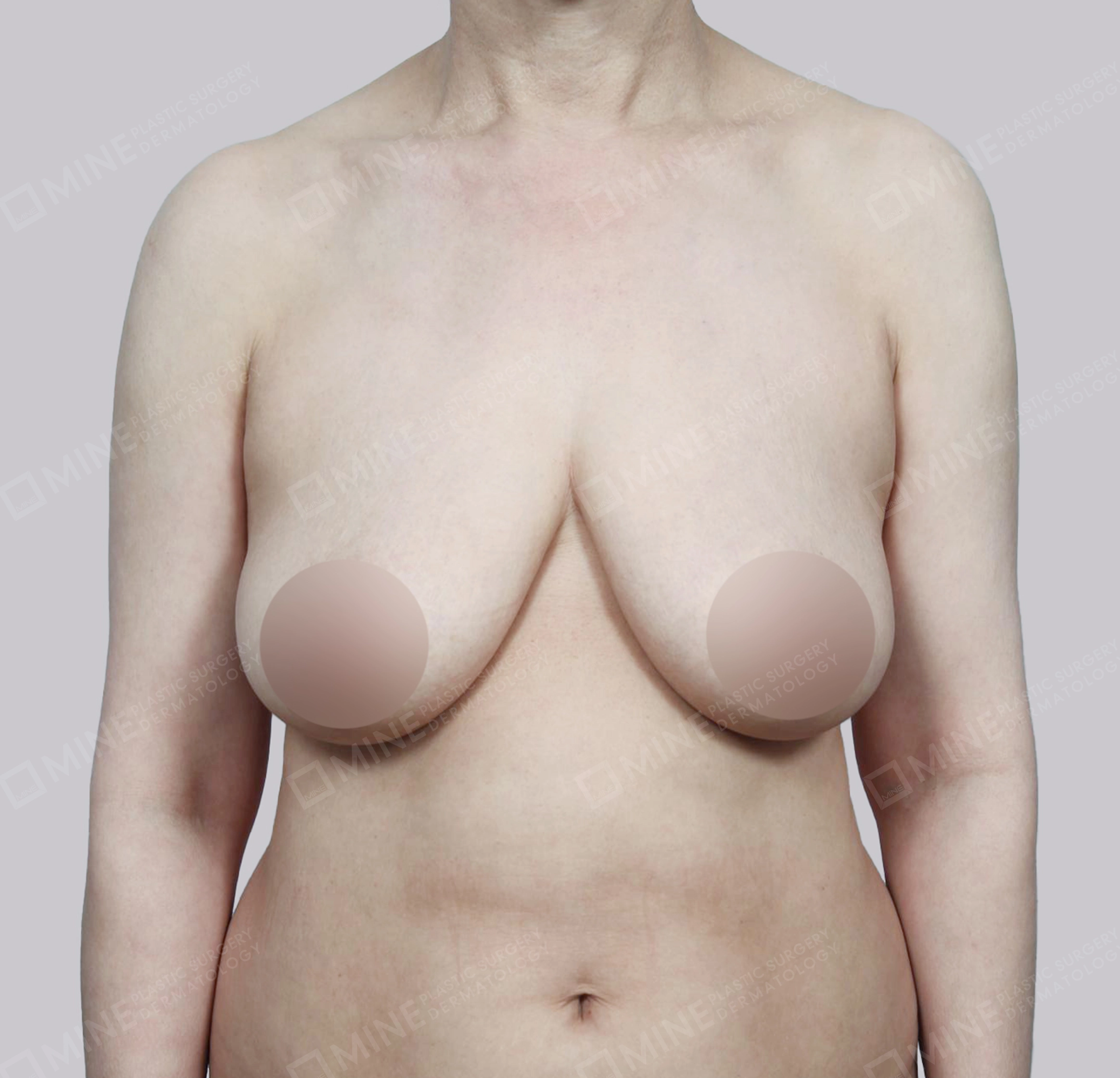 Breast Reduction-정면-전
