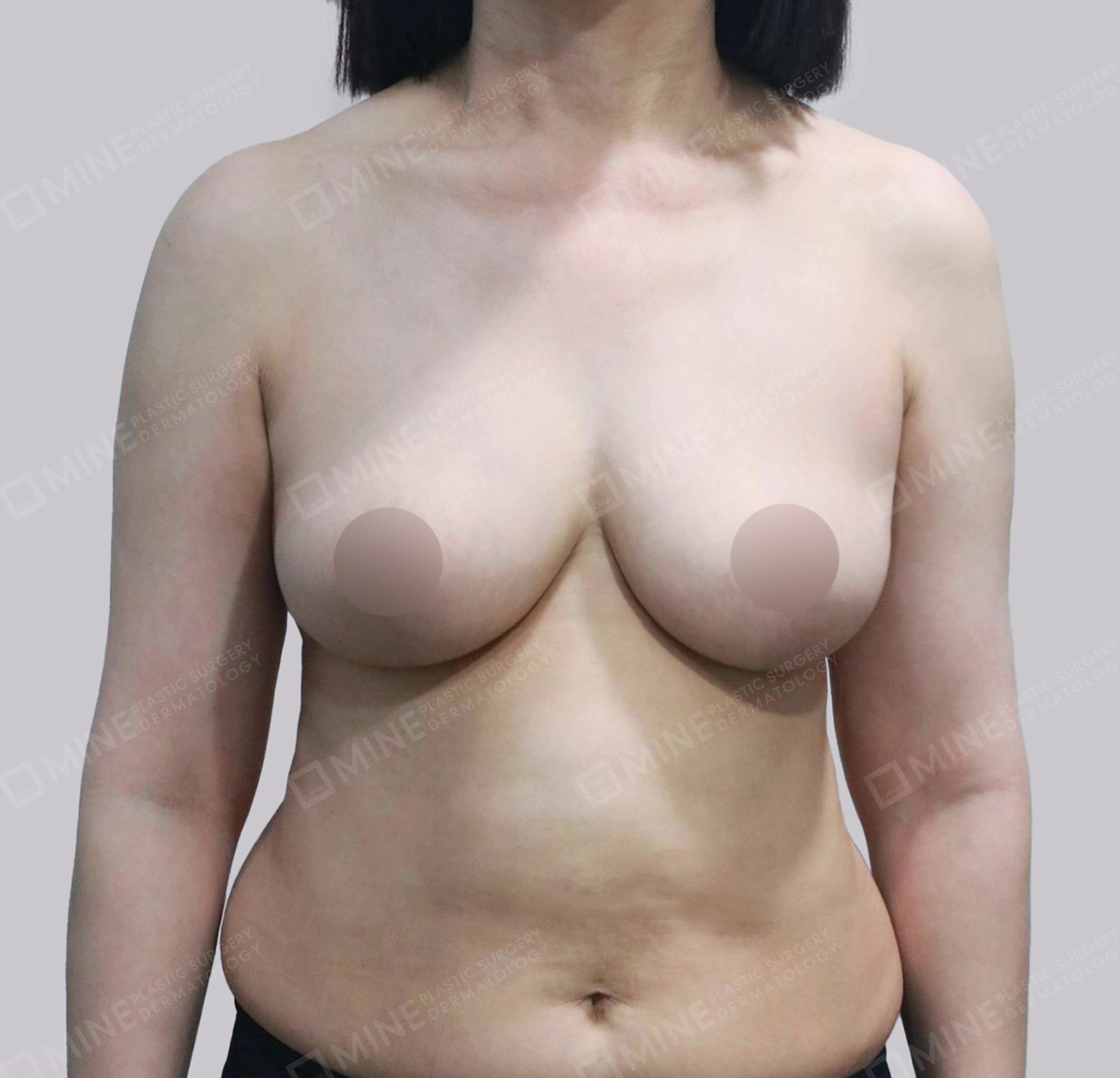 Breast Reduction-정면-후