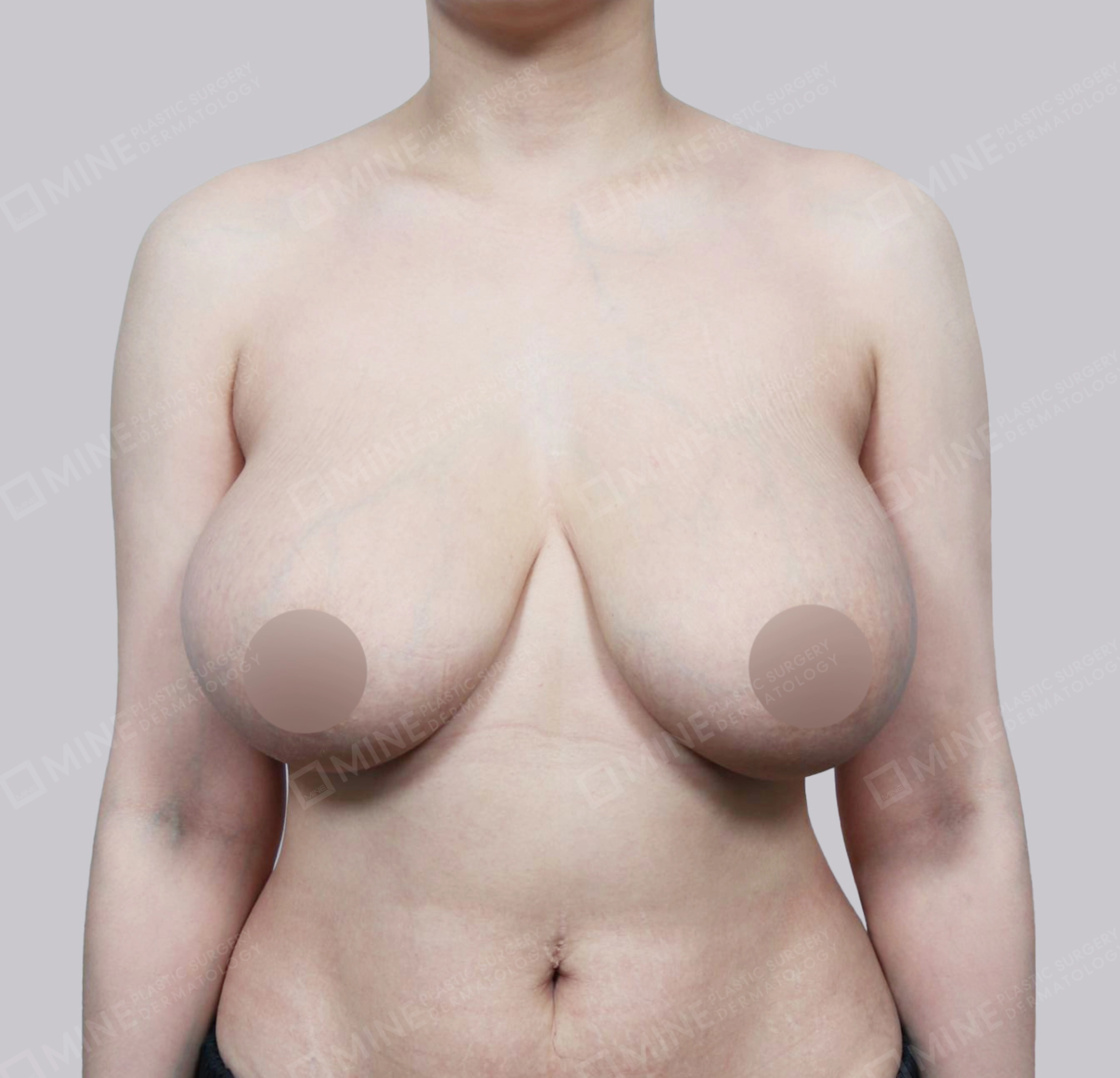 Breast Reduction-Front-Before