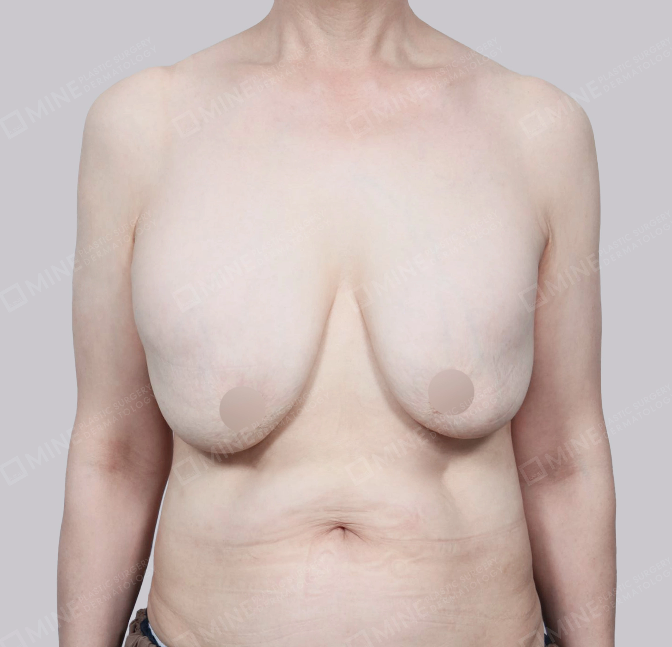 Breast Reduction-Front-Before