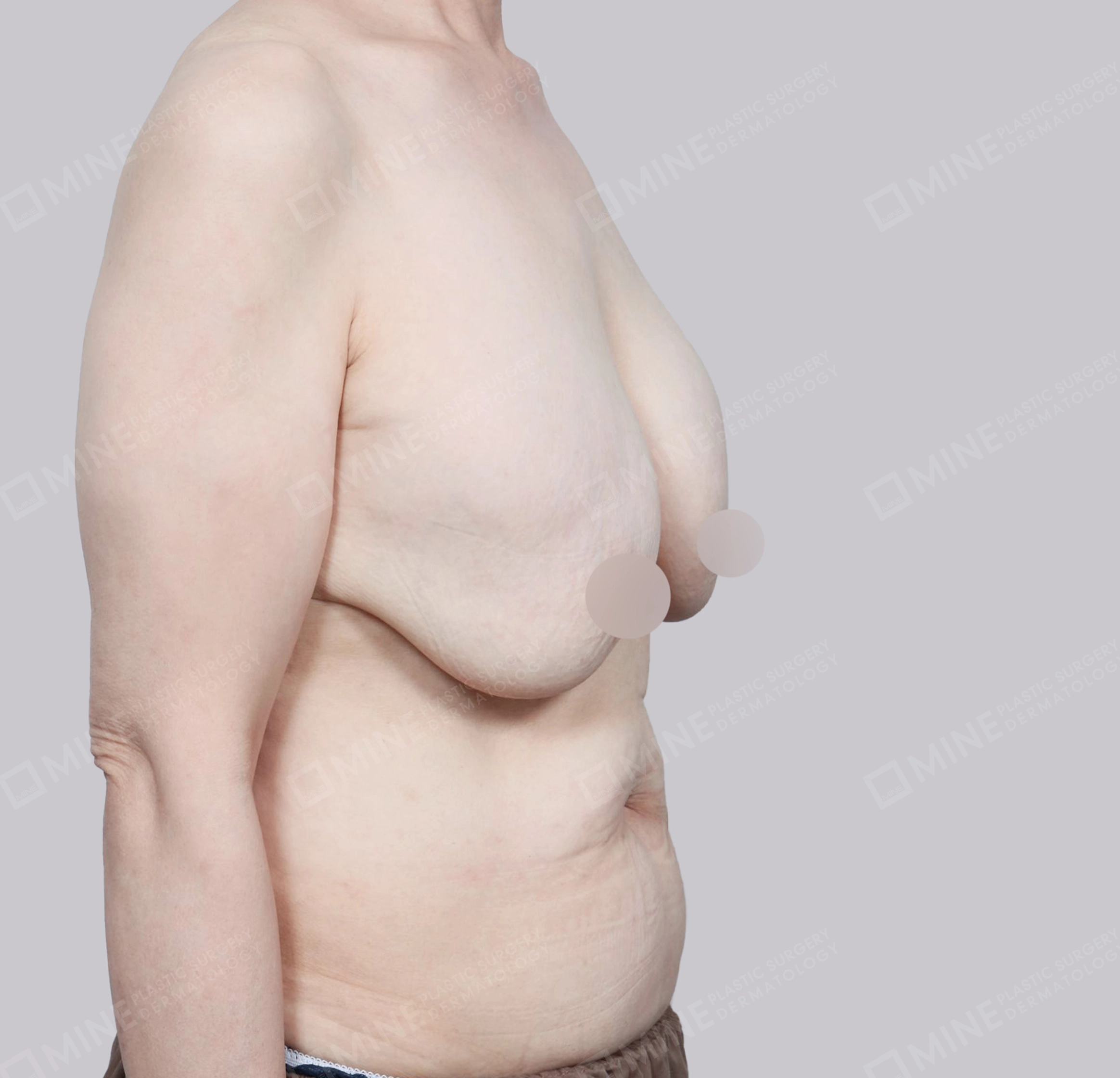 Breast Reduction-45-Degree-Before