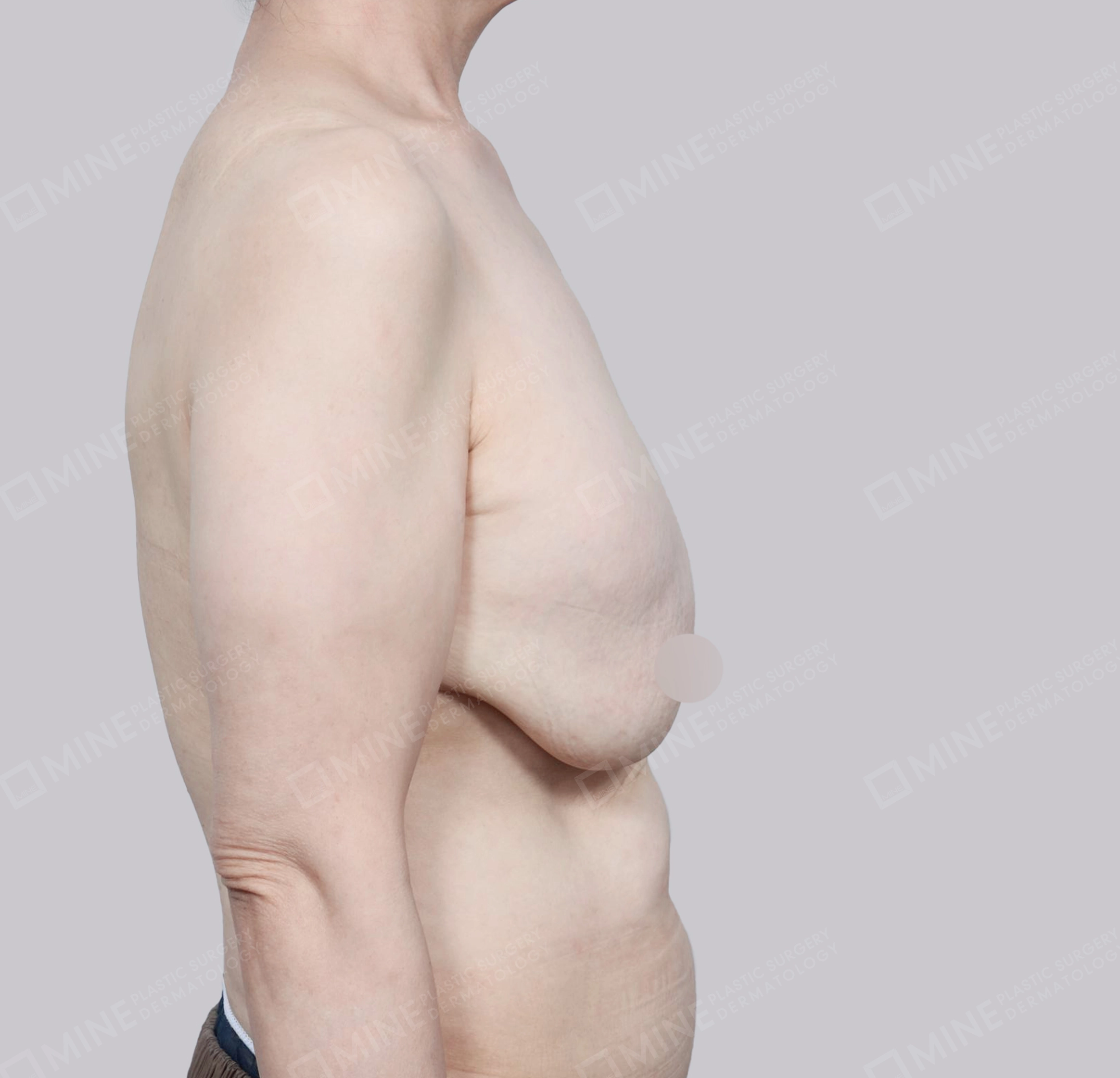 Breast Reduction-Side-Before