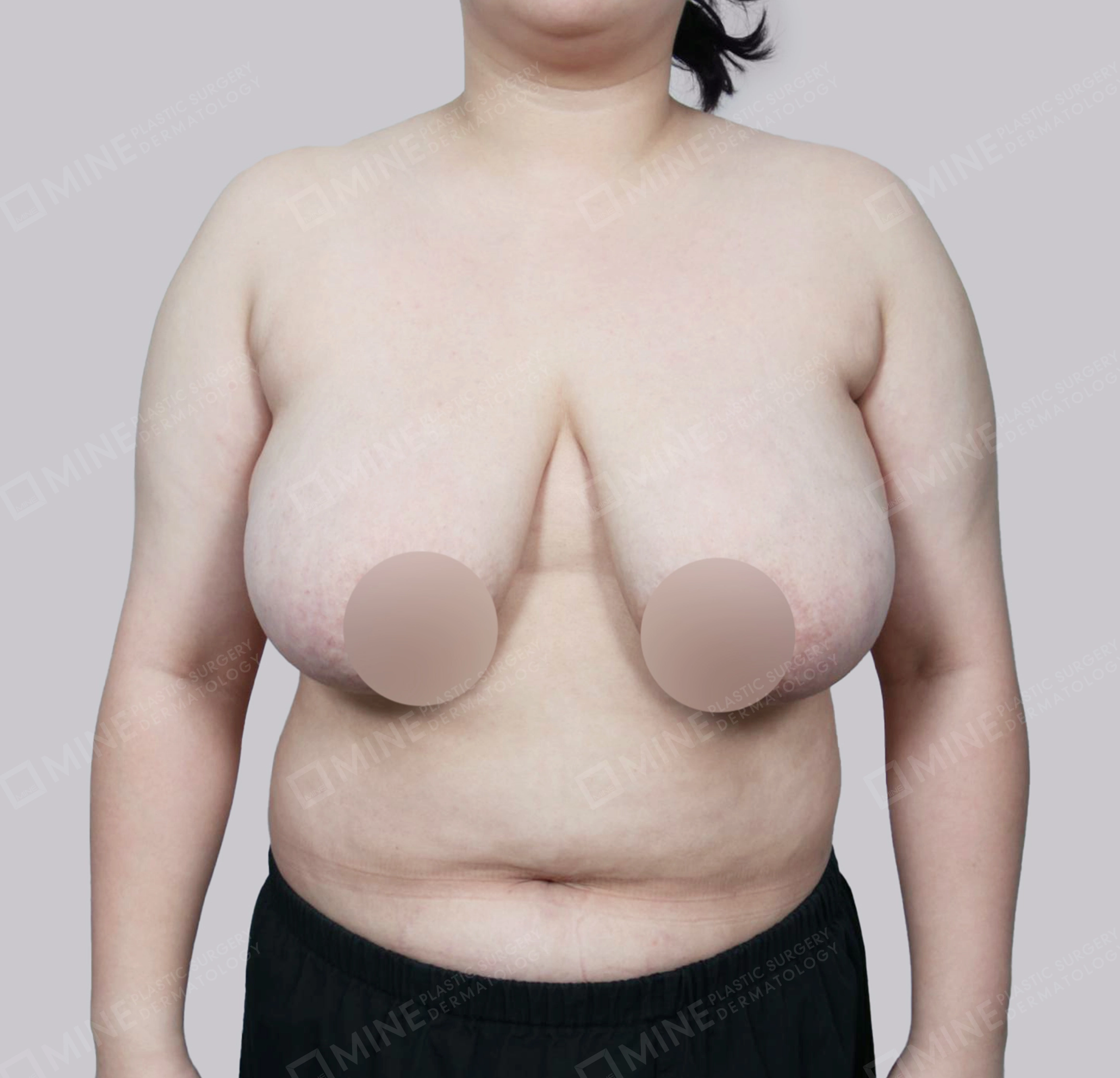 Breast Reduction-Front-Before
