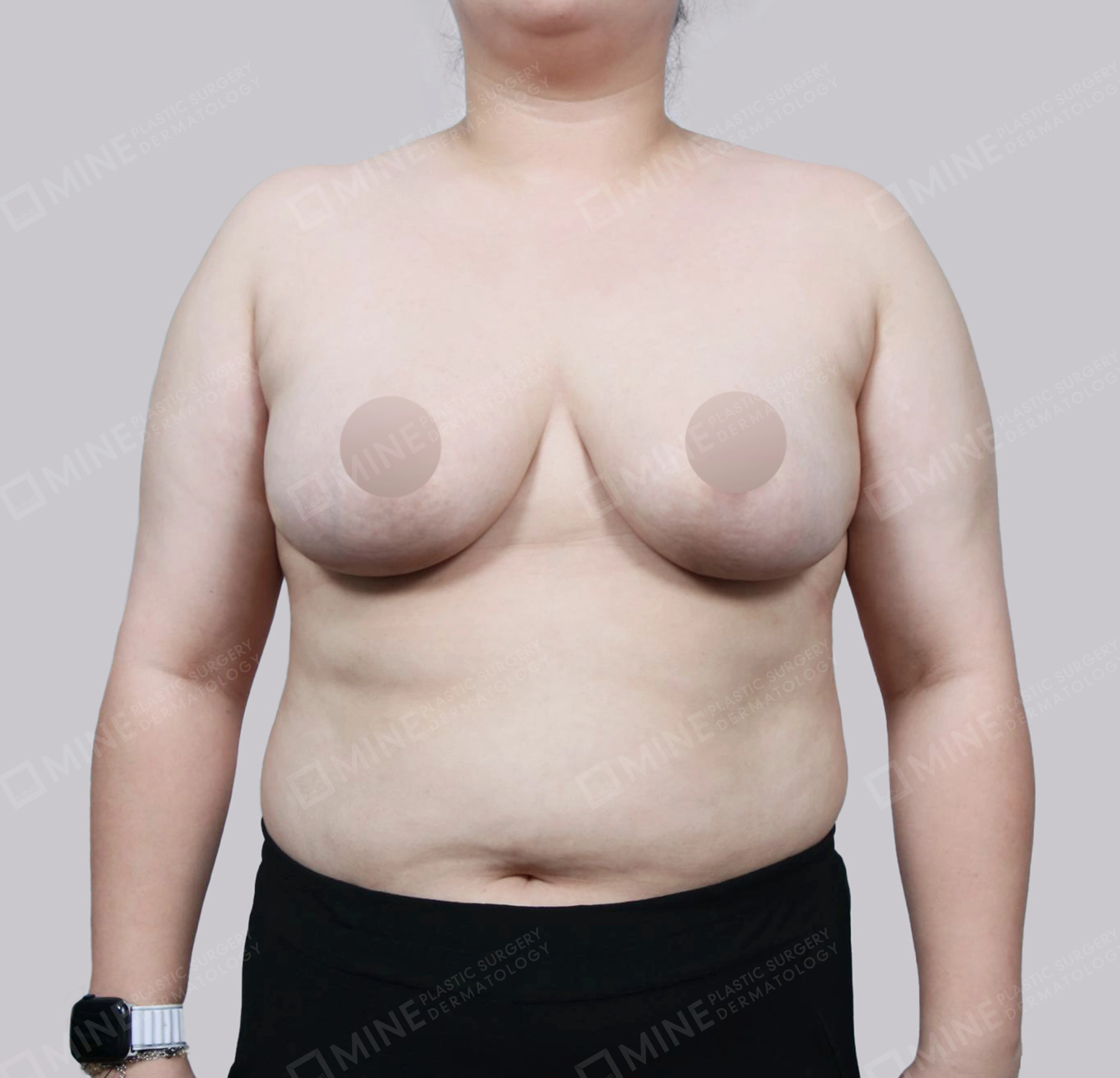 Breast Reduction-Front-After