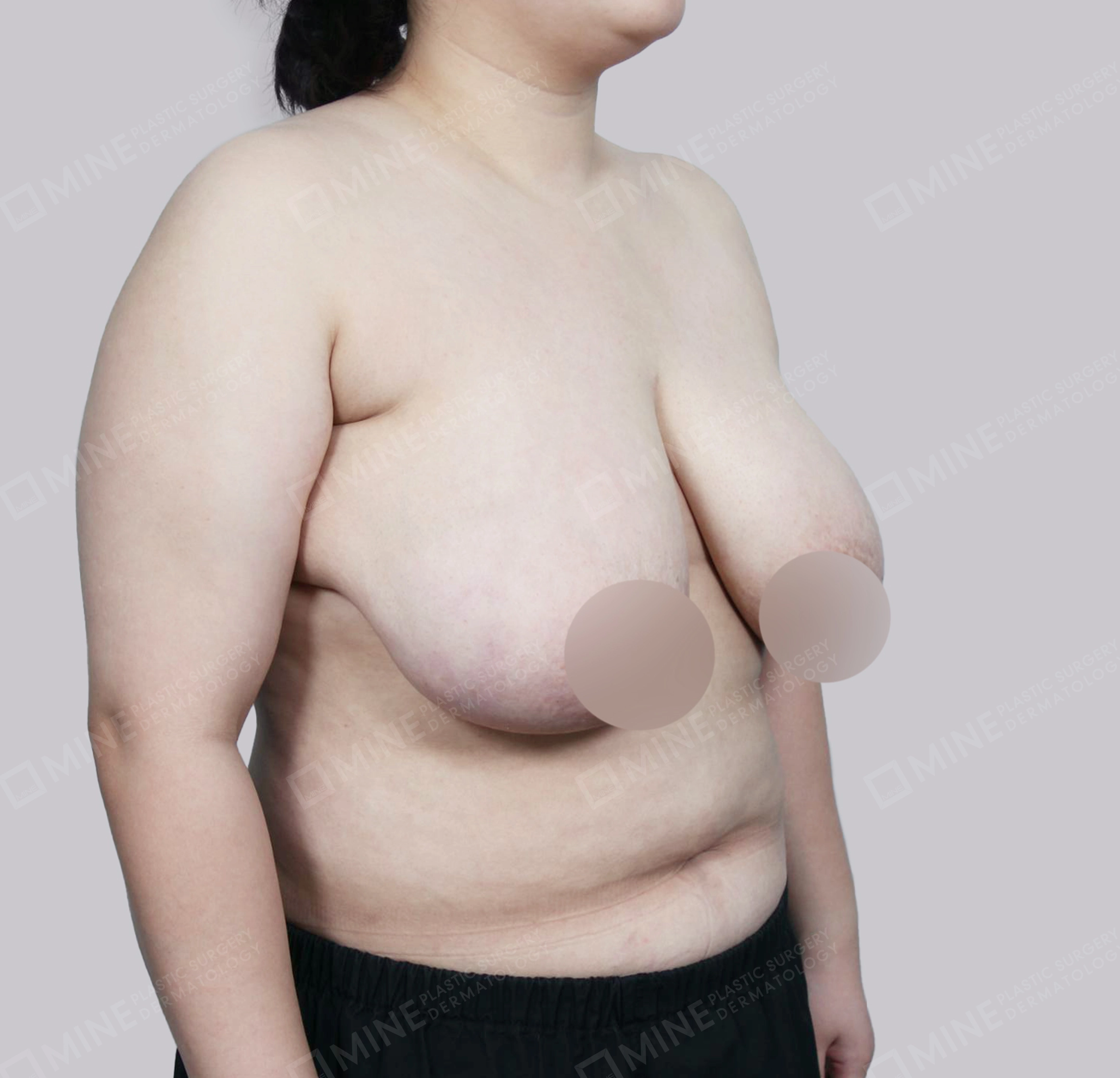 Breast Reduction-45-Degree-Before