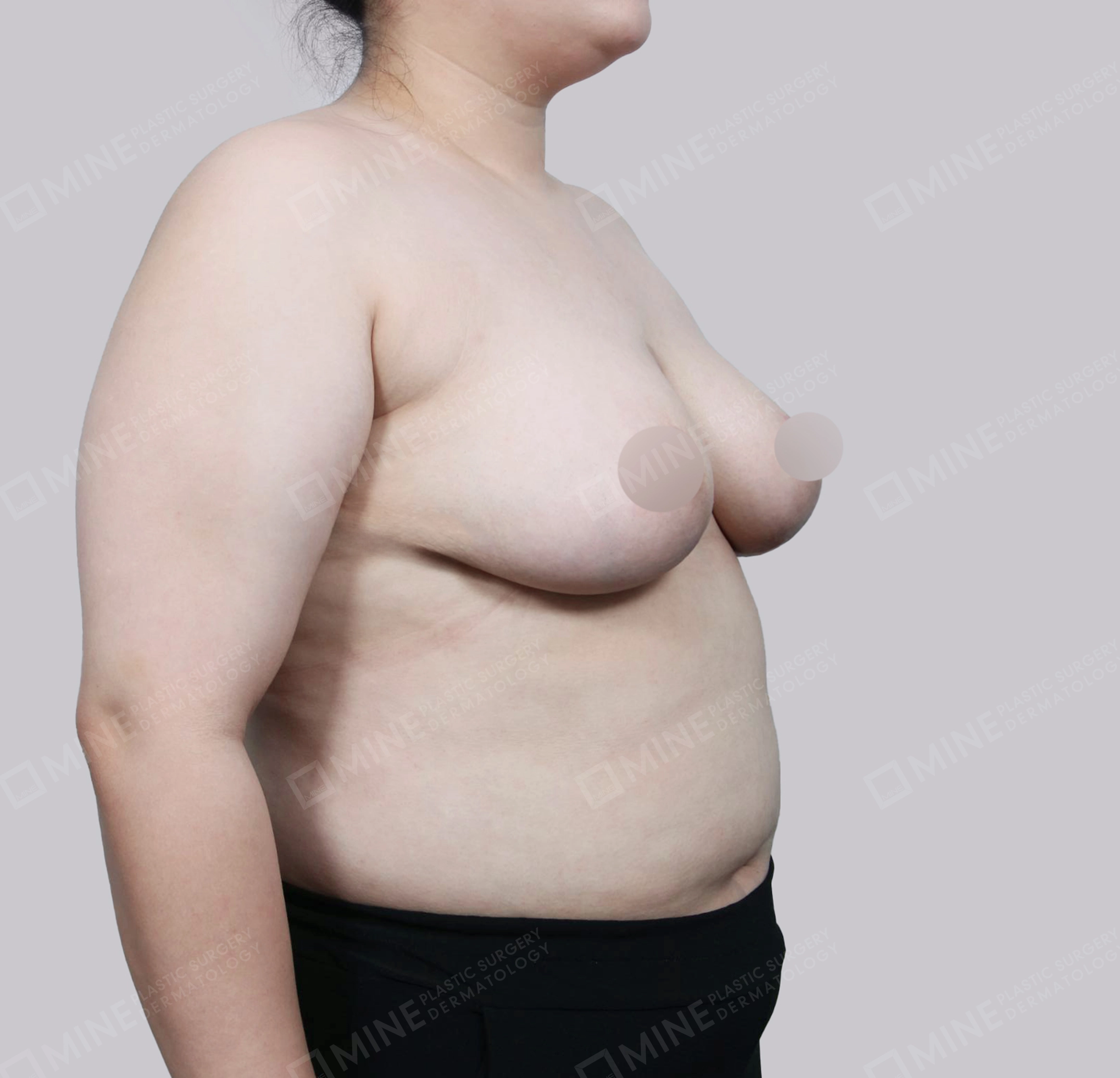 Breast Reduction-45-Degree-After