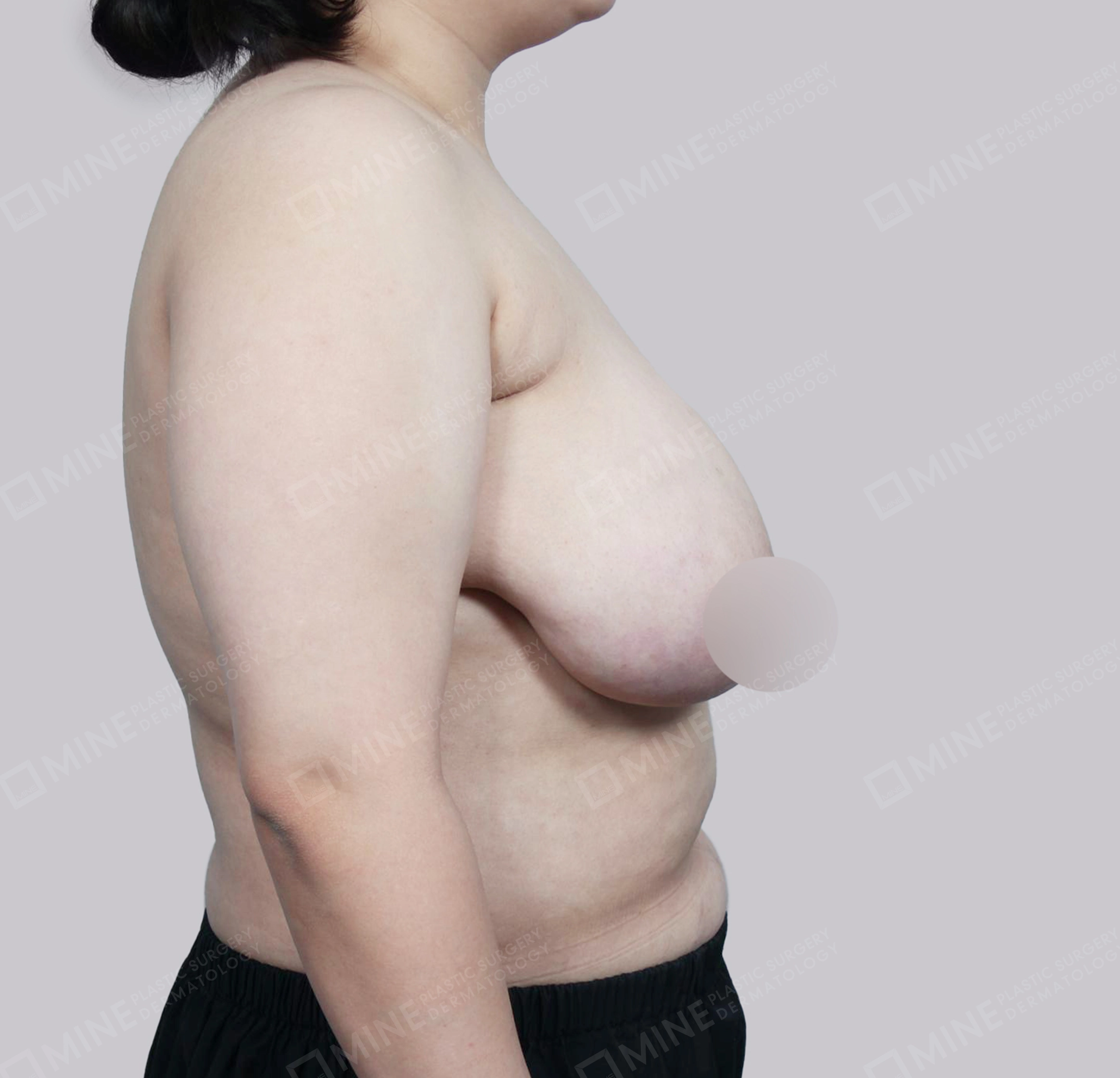 Breast Reduction-Side-Before