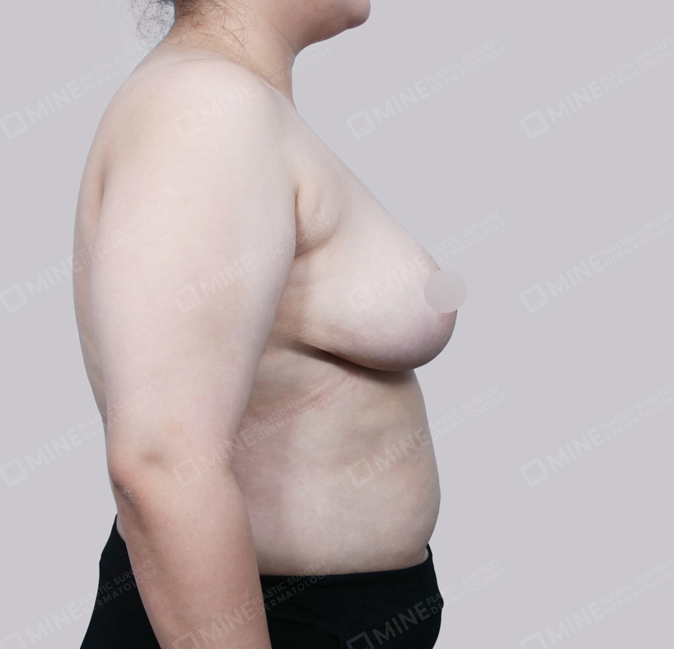 Breast Reduction-Side-After