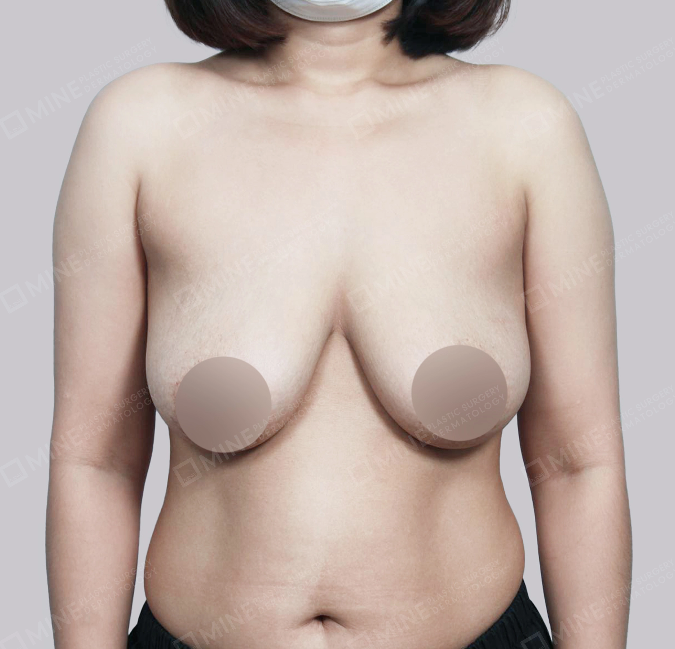 Breast Reduction-Front-Before