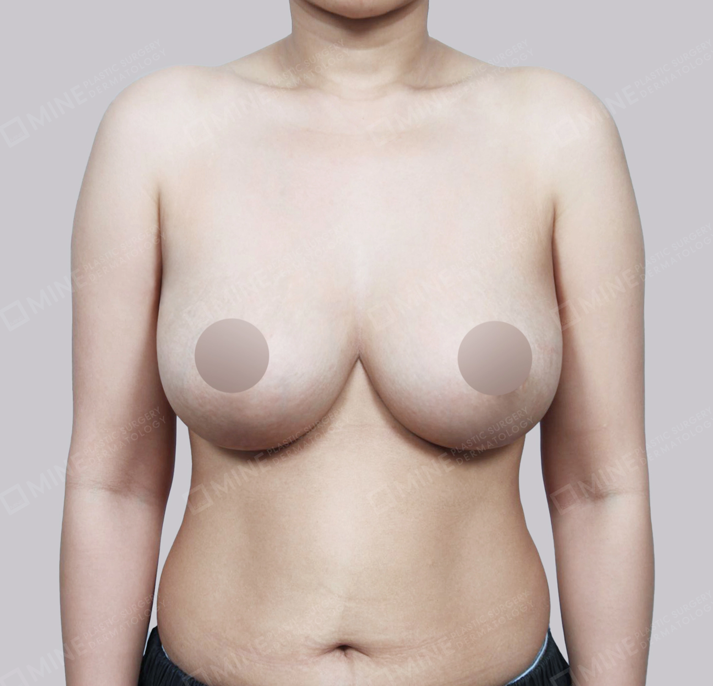 Breast Reduction-Front-After