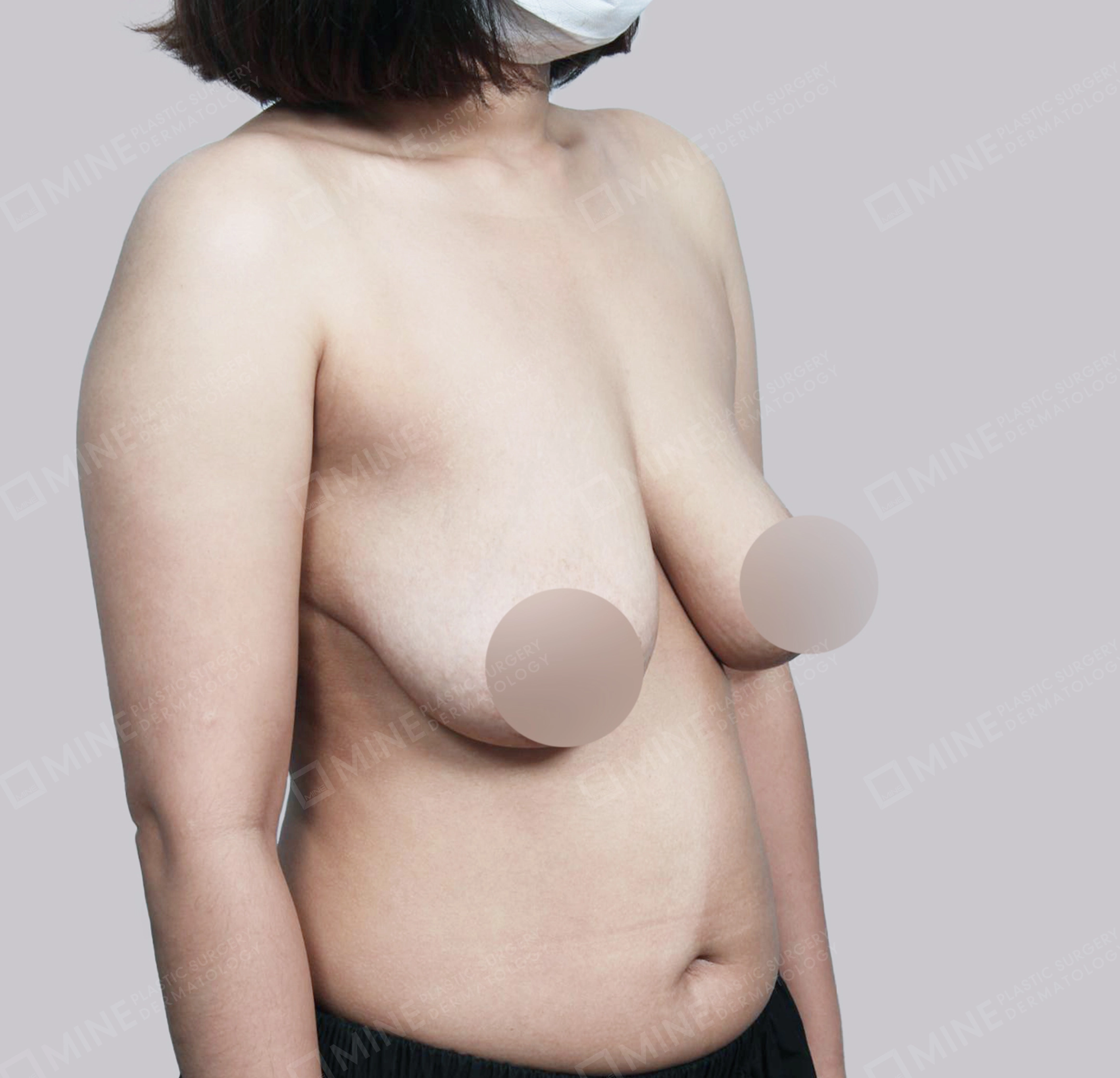 Breast Reduction-45-Degree-Before