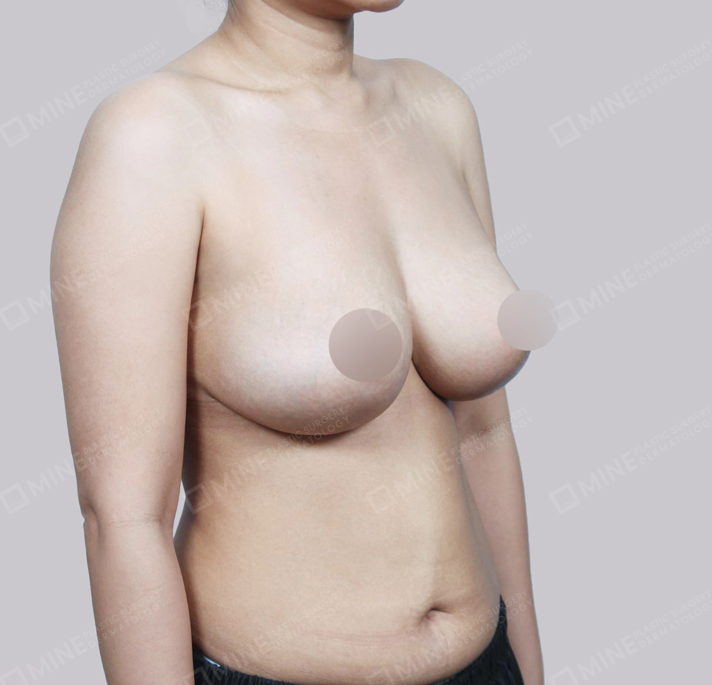 Breast Reduction-45-Degree-After