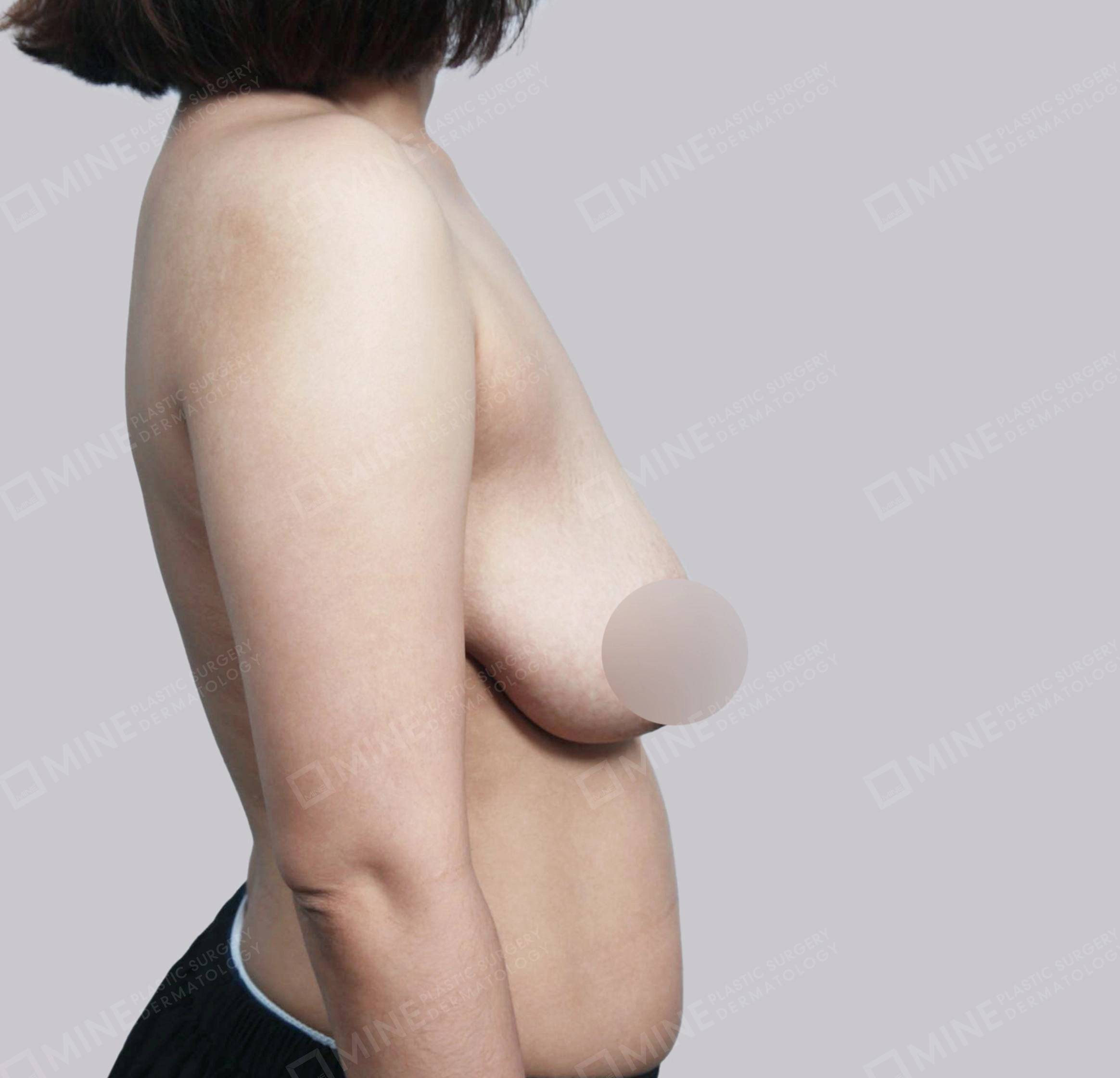 Breast Reduction-Side-Before
