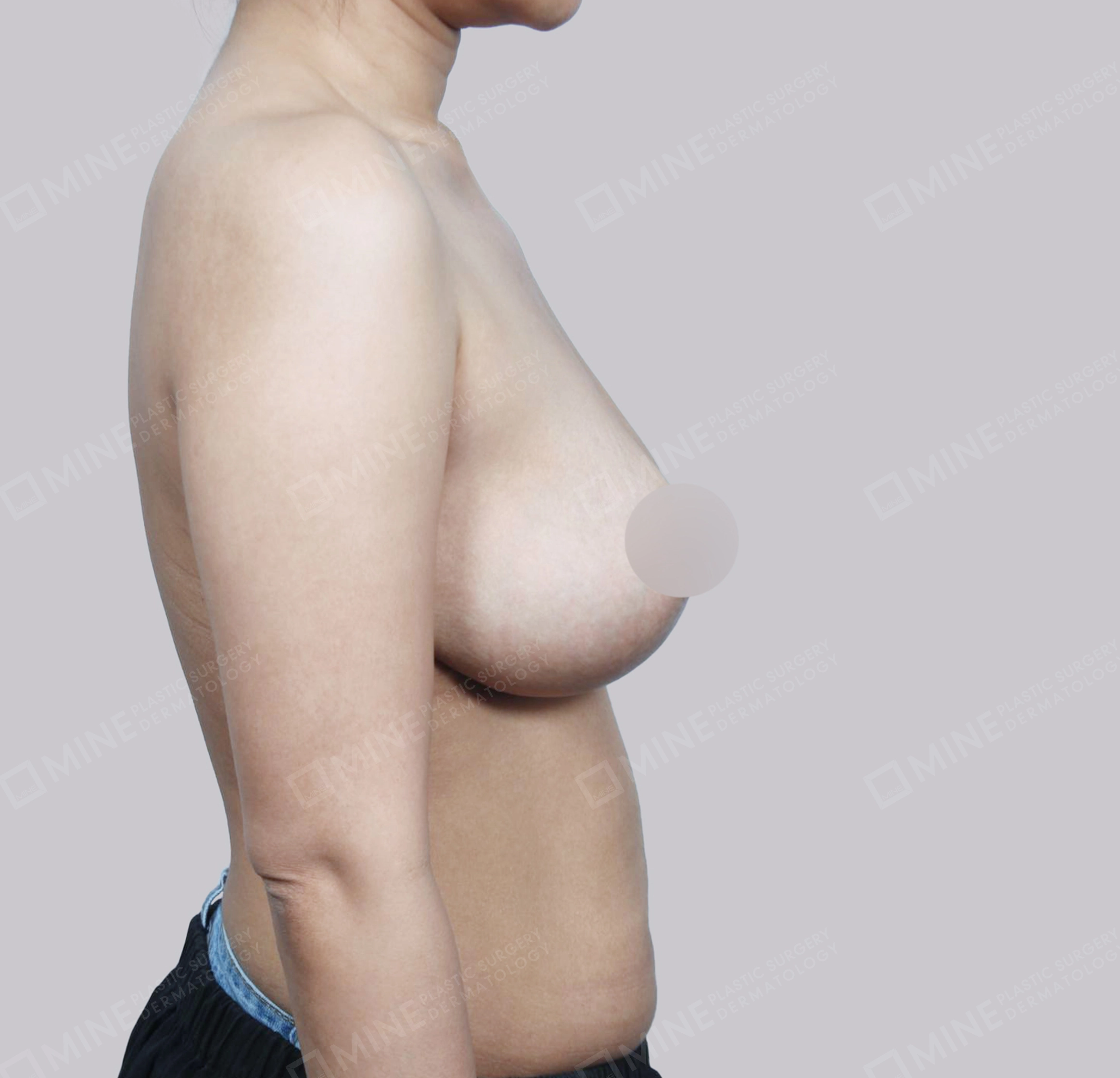 Breast Reduction-Side-After