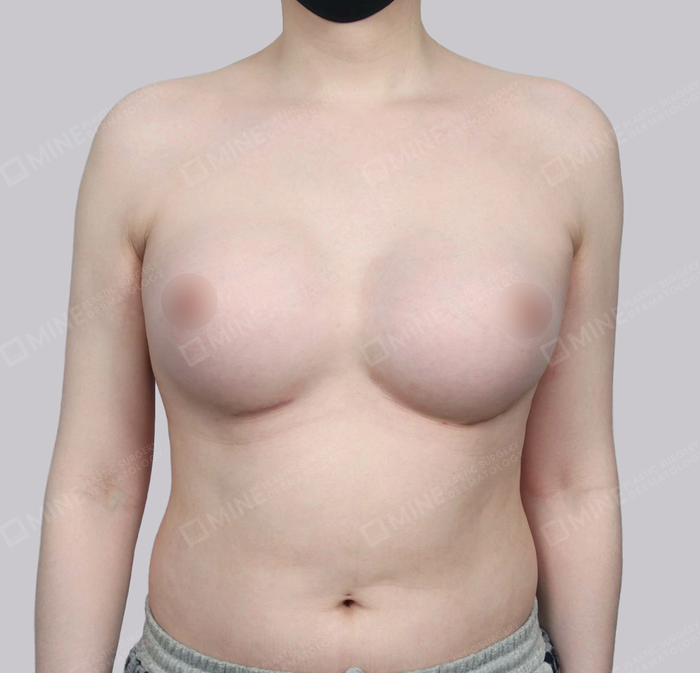 Breast Revision (Symmastia)-정면-전