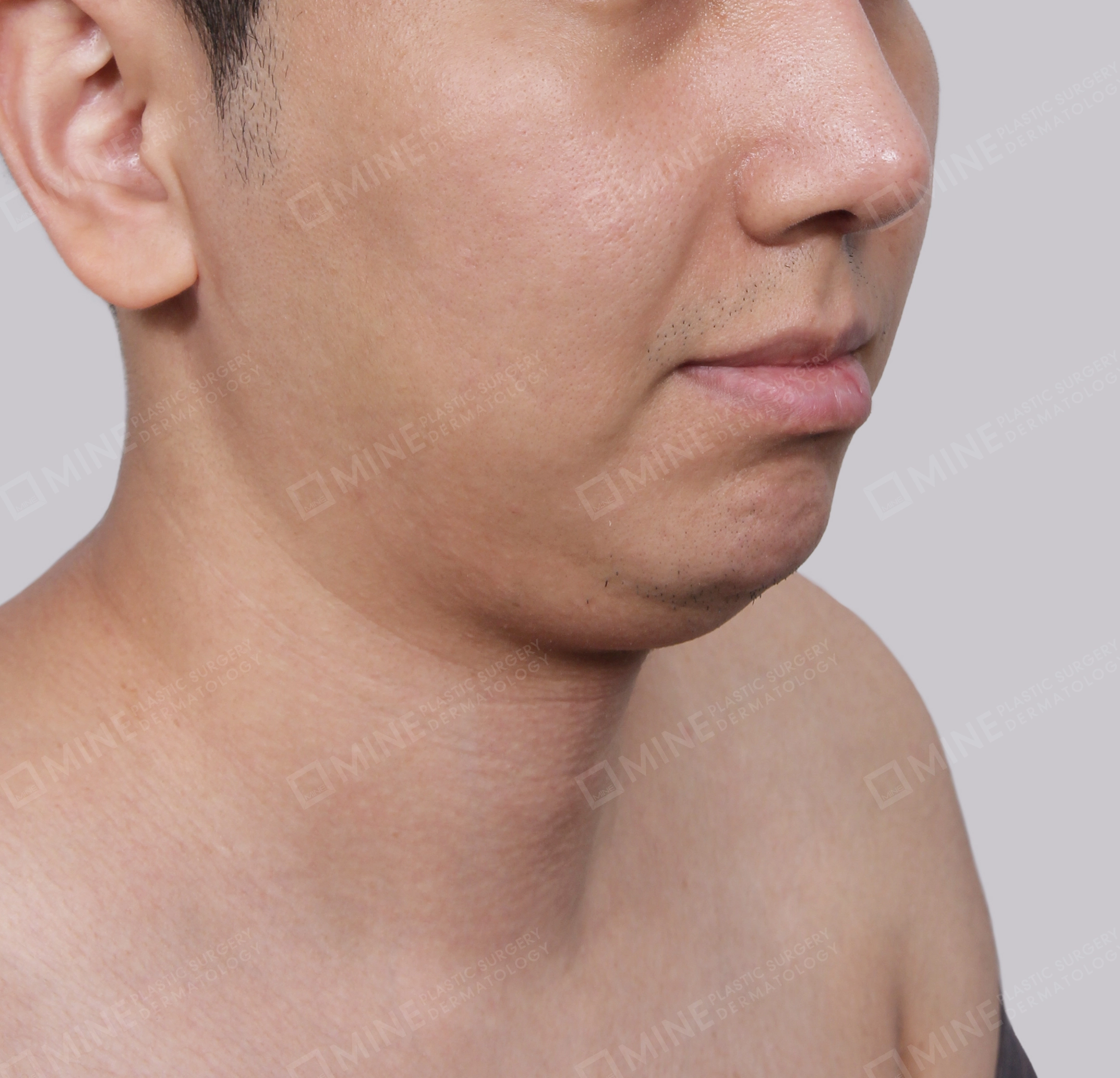 Double Chin-정면-전